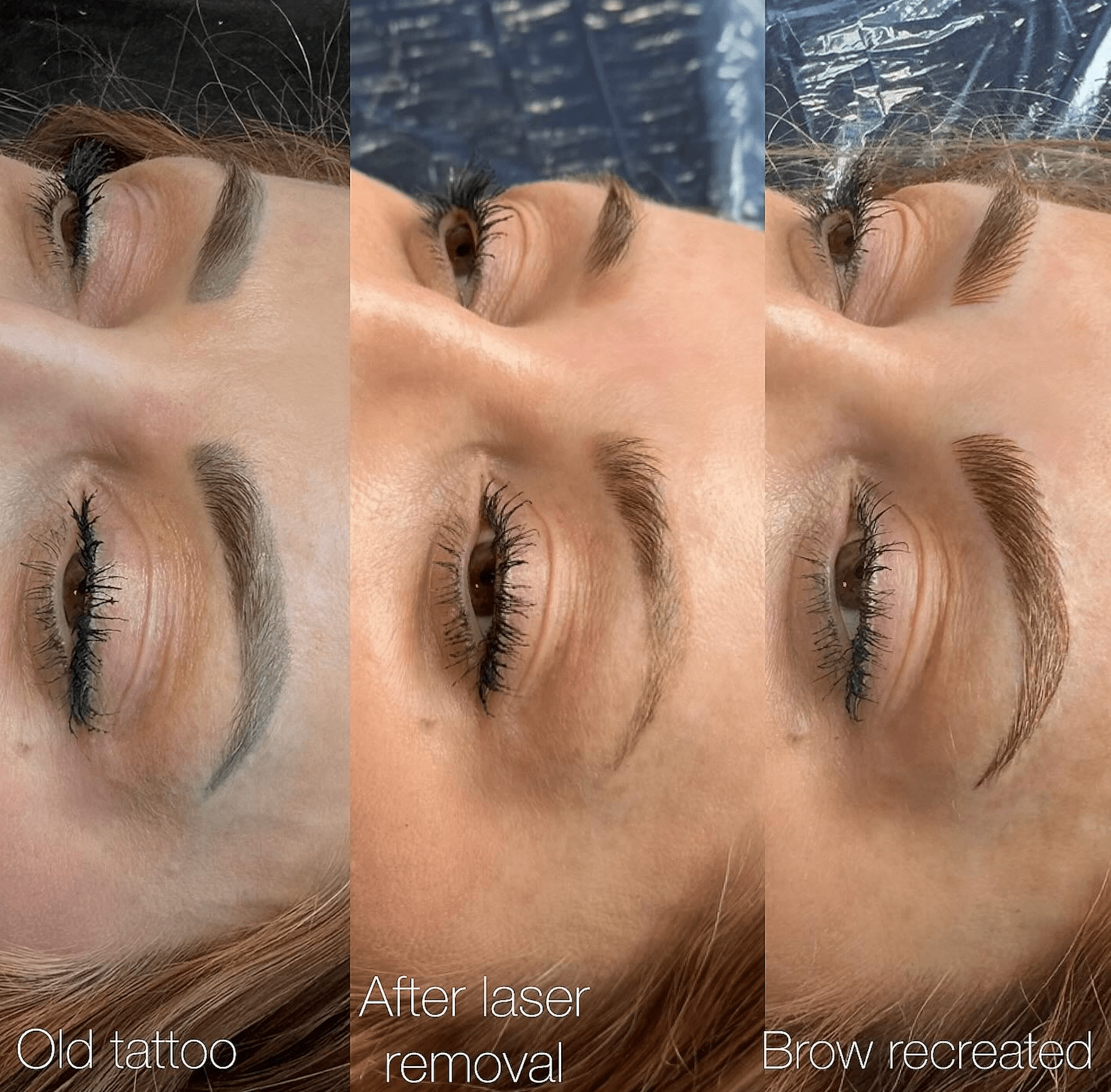 Why Laser Removal Might Be Your Secret Weapon for Beautiful Brows
