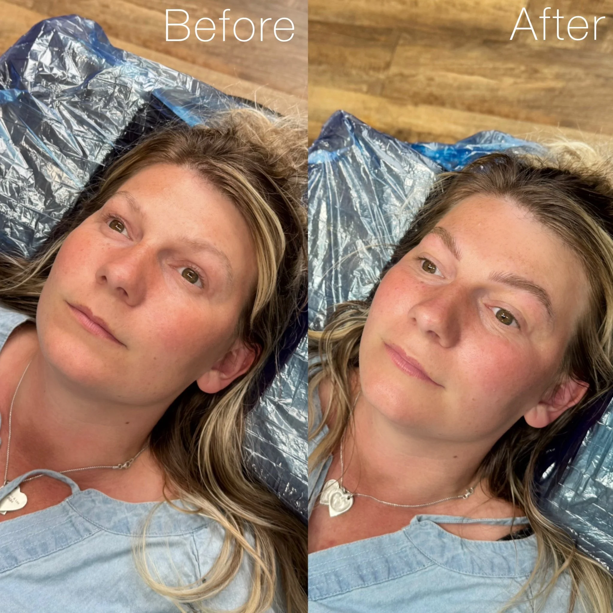 Side-by-side comparison of a woman lying on a surface covered with a silver blanket, showing before and after results of a cosmetic procedure. The "Before" side shows her natural skin tone and eyebrows, while the "After" side shows her with more defi