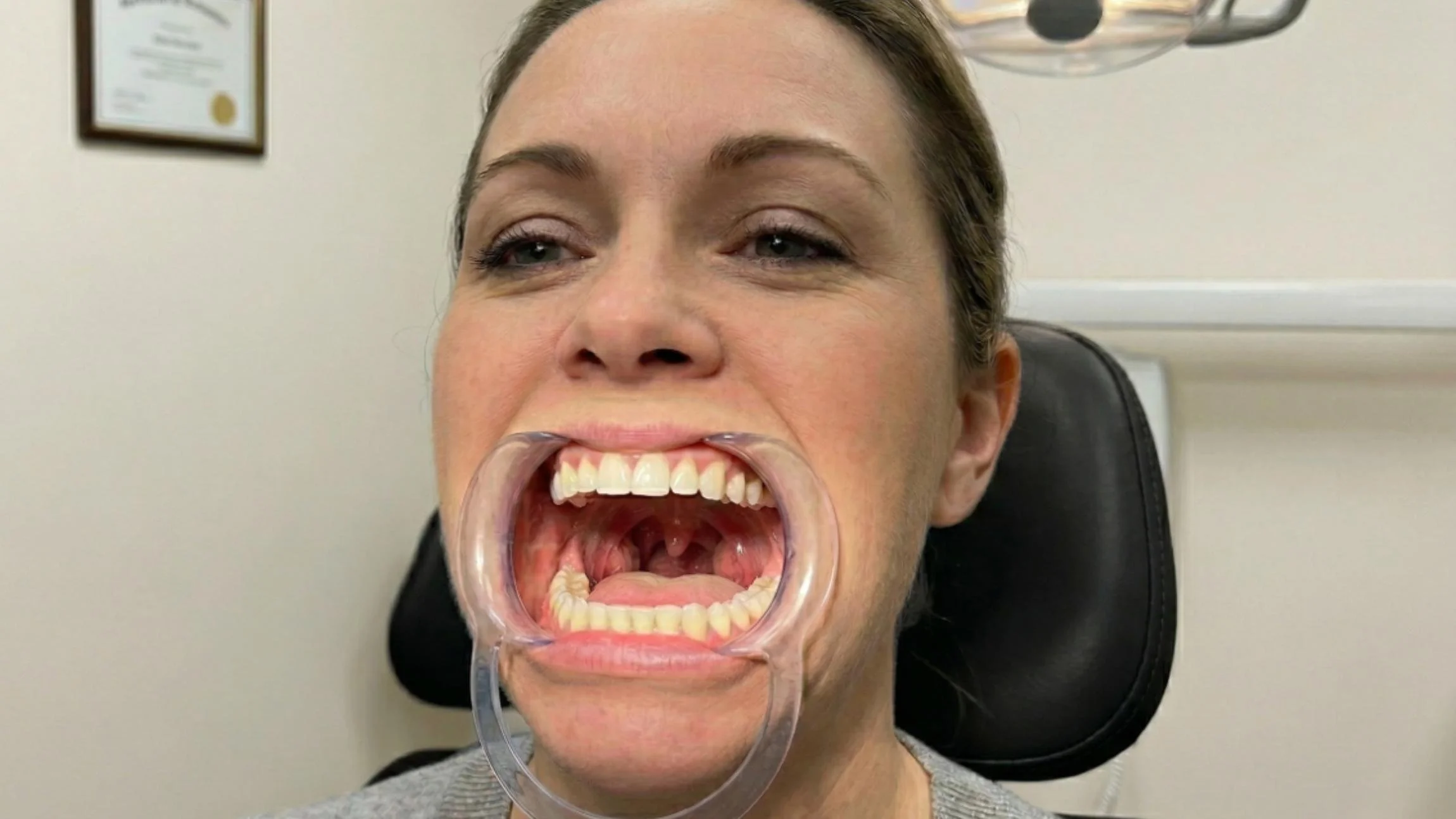 Tonsil Stones: Why You Get Them &amp; How to Remove Them Safely