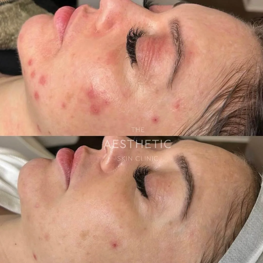 The power of light therapy for this beautiful patient ✨🤍 
A short series of our Dermalux Light Therapy to treat peri oral and orbital dermatitis. 
#TASC #SkinHealth #CosmeticClinic
