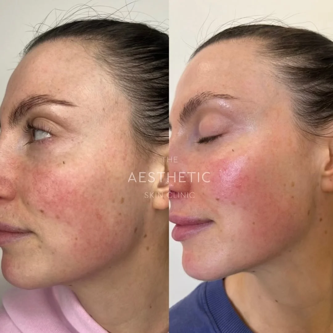 Healthy Skin In Progress ✨ 
This beautiful client has been treated with microneedling + NCTF Boost. One of our favourite combinations for restoring overall skin health, brightening, deep hydration, and improving pigmentation.
Her skin is now radiat