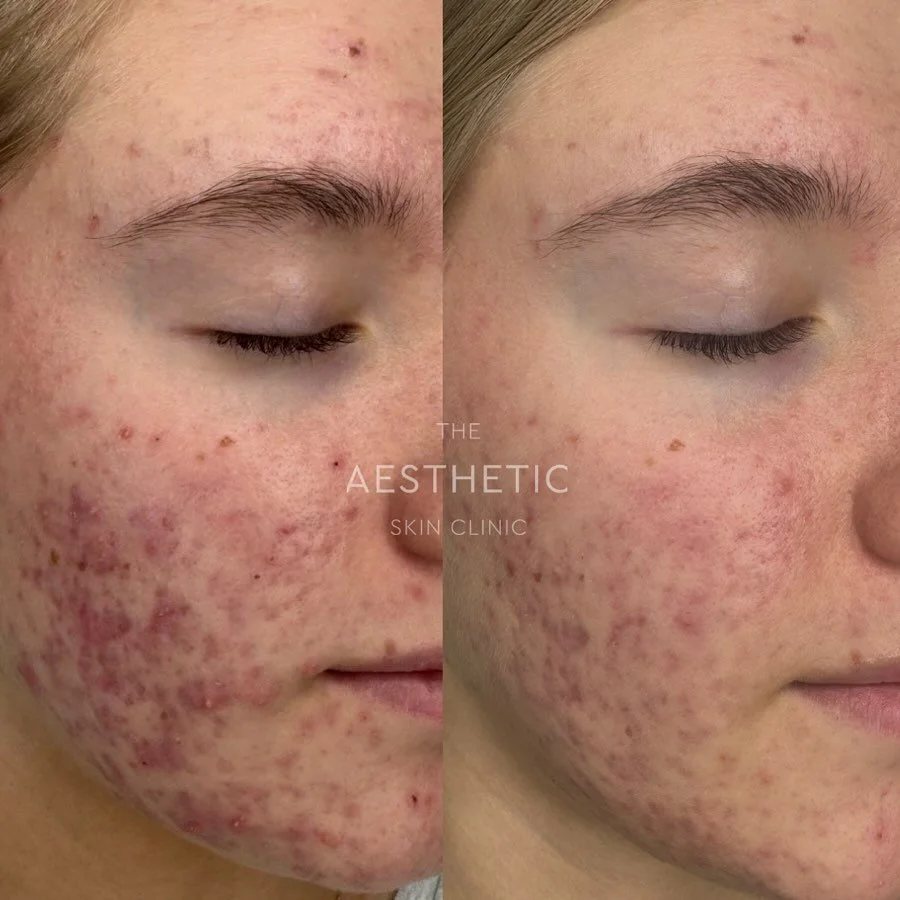 Acne Healing Journey: Real Results, Real Progress ✨

This beautiful young client has been so consistent and dedicated to her skin journey 🤍

We began with a series of Tri-Wave Light Therapy sessions combined with a simple yet powerful iS CLINICAL ho
