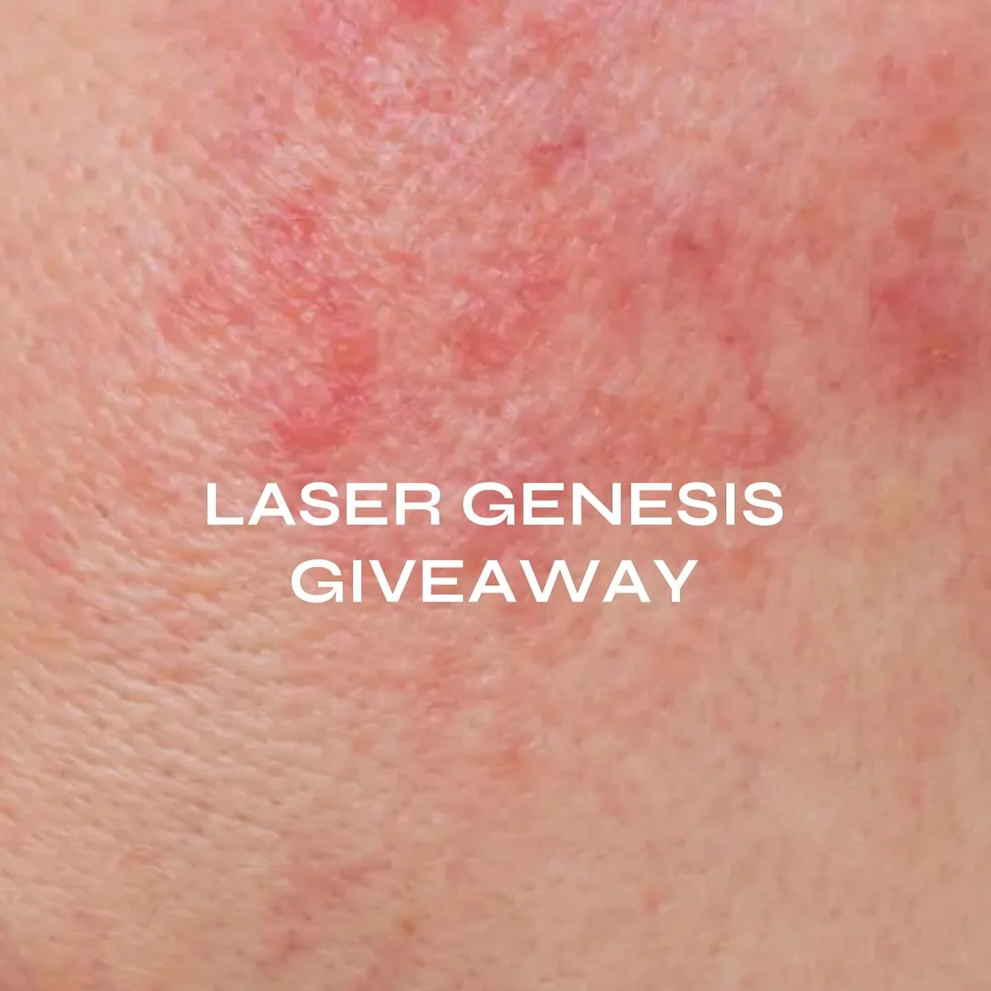 Laser Genesis Giveaway ✨ 

Celebrating our new XEO laser in clinic, we are gifting away 3 beautiful Laser Genesis Treatments valued at $299 each. The treatment our clients can&rsquo;t stop talking about.

Think: smoother texture, refined pores, a sof