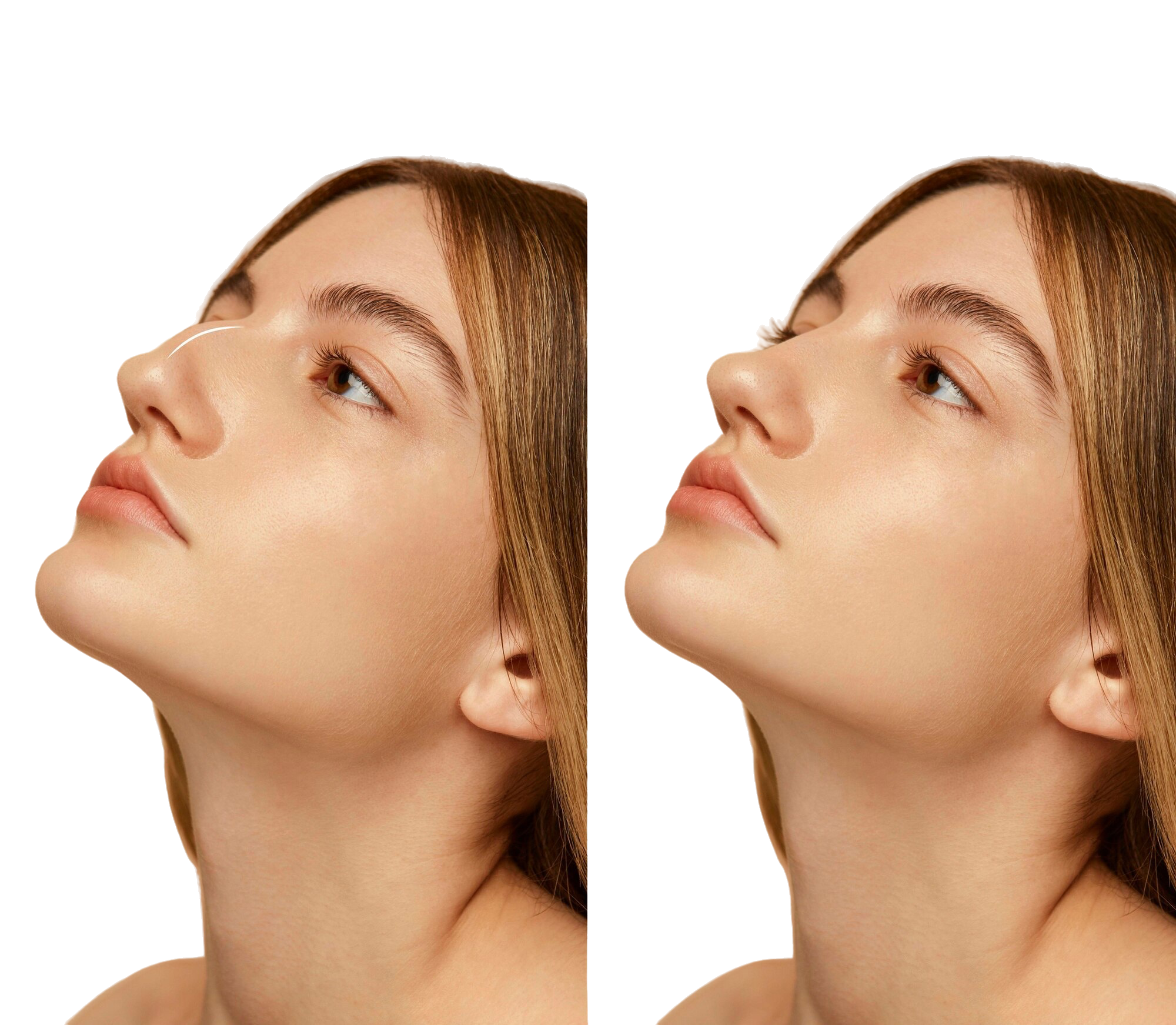 woman-getting-ready-nose-job-surgery.png
