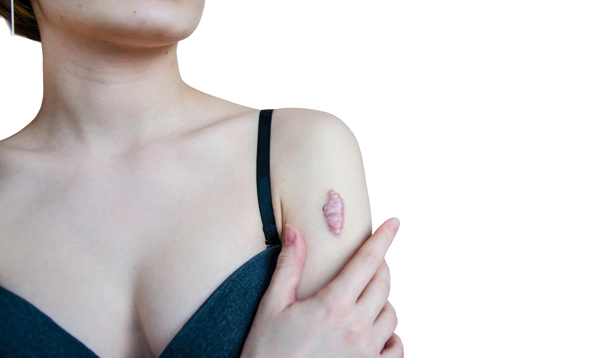 closeup-keloid-scar-shoulder-young-woman-rough-scar-tumorlike-growth-coarse-fibrous-connective-tissue-skin-treatment-laser.png