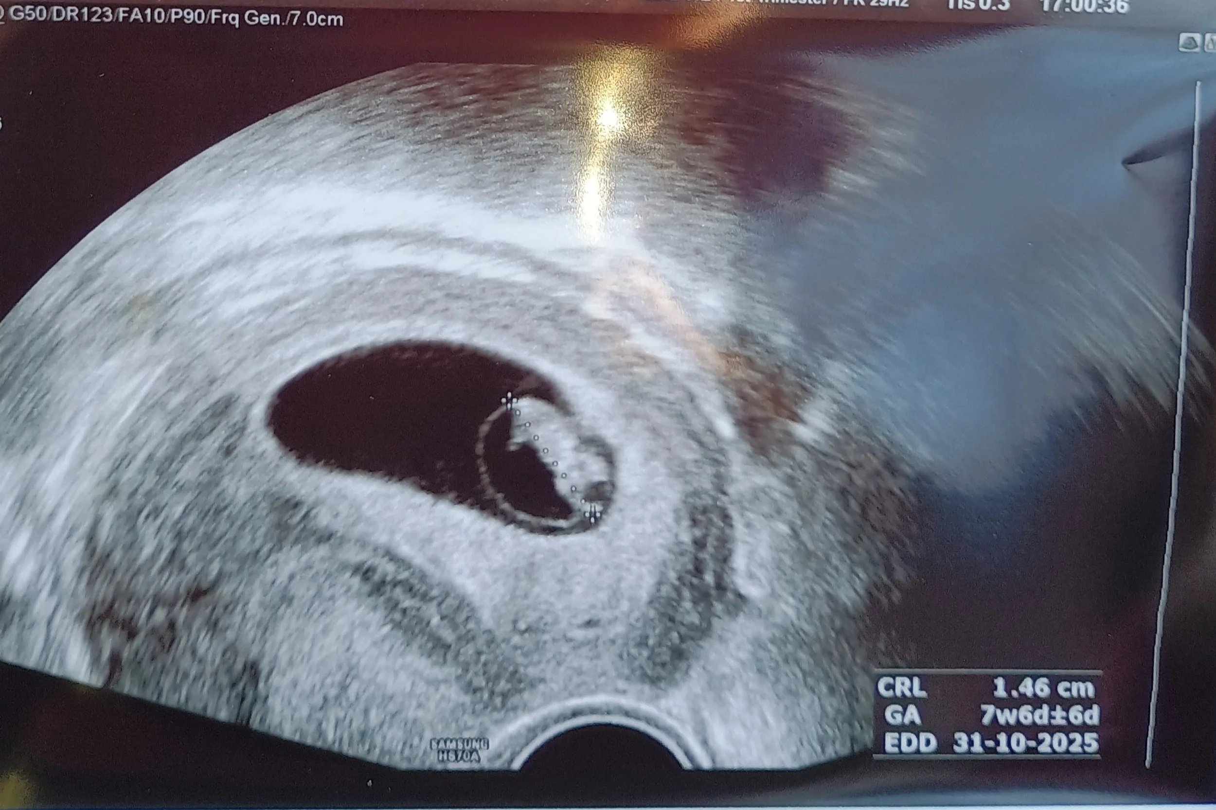 Mijn eerste trimester – een rollercoaster met diabetes