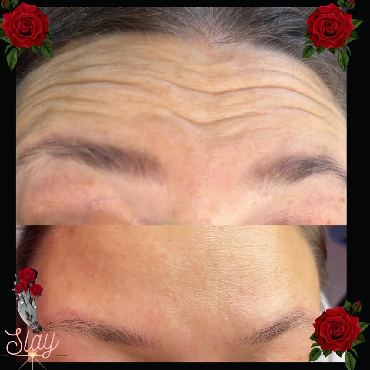 💫 The magic of Anti Wrinkle Treatments 😍