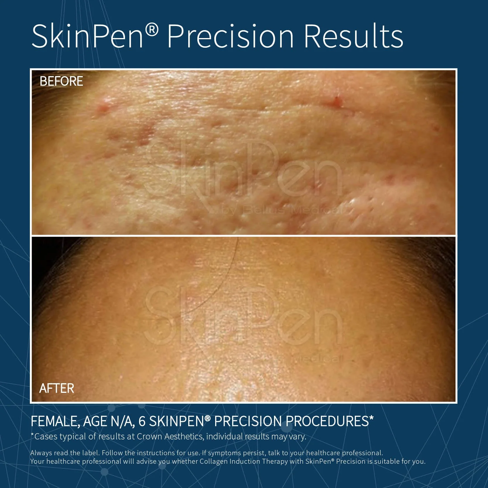before and after of SkinPen skin needling Rejuved Bateau Bay