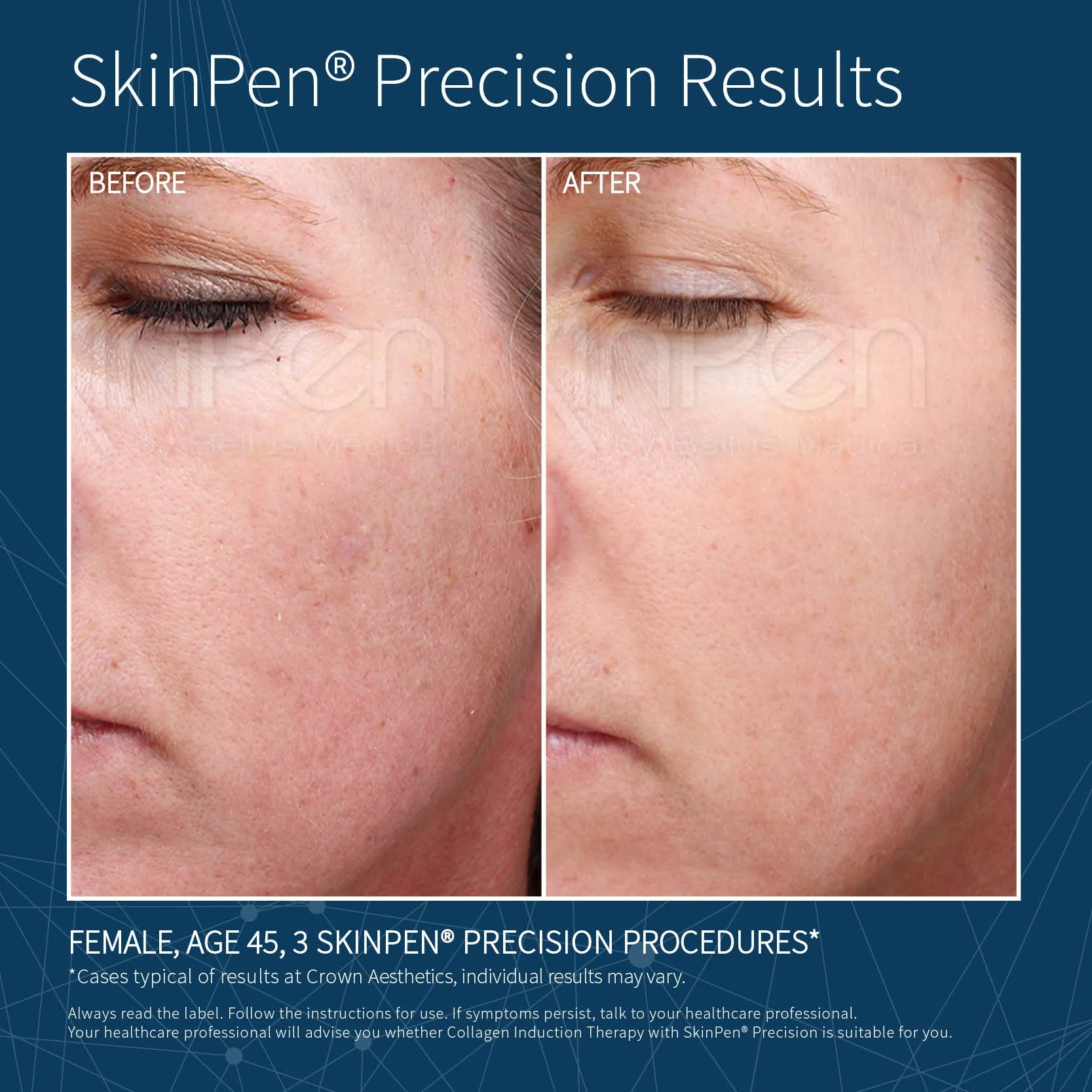 before and after of SkinPen skin needling Rejuved Bateau Bay