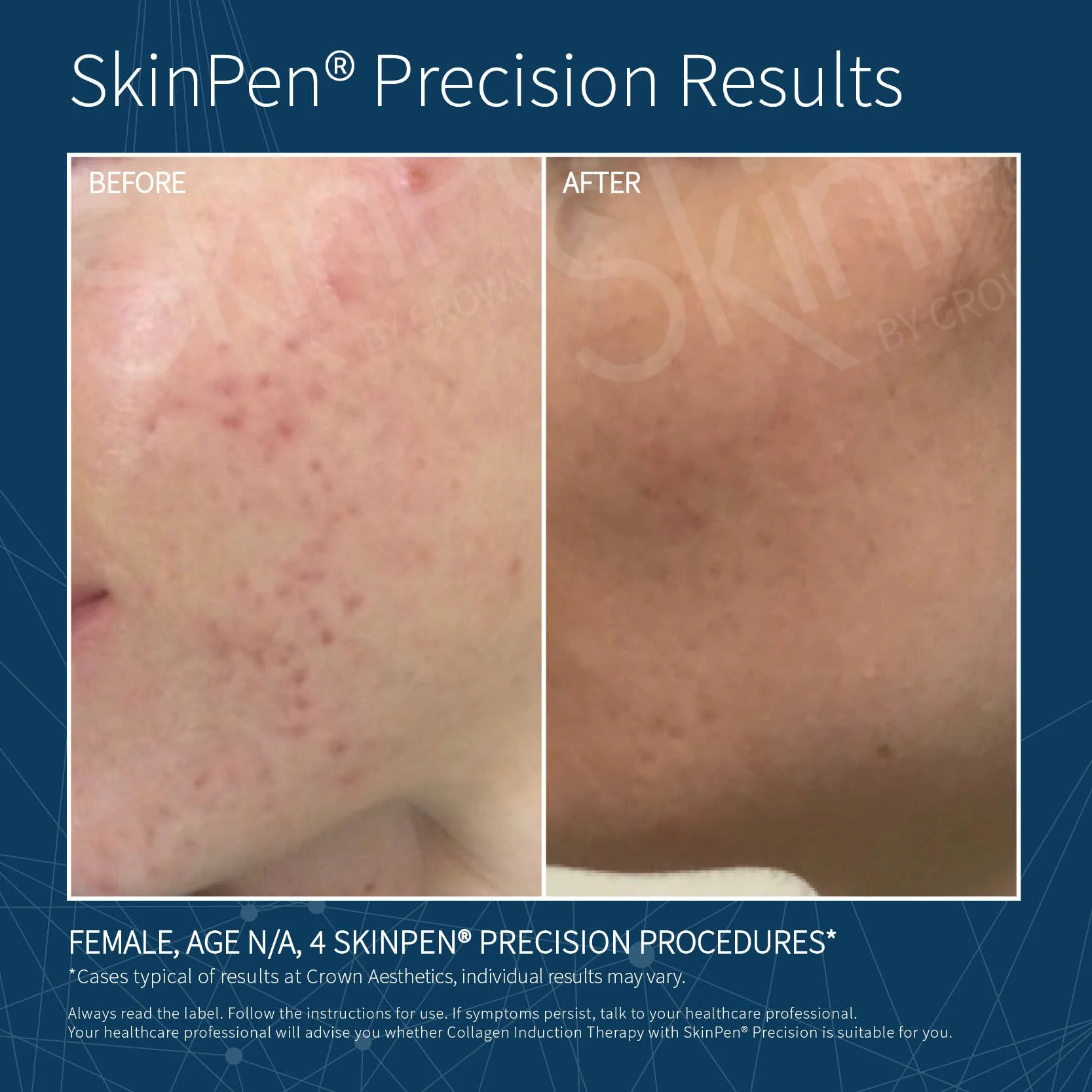 before and after of SkinPen skin needling Rejuved Bateau Bay