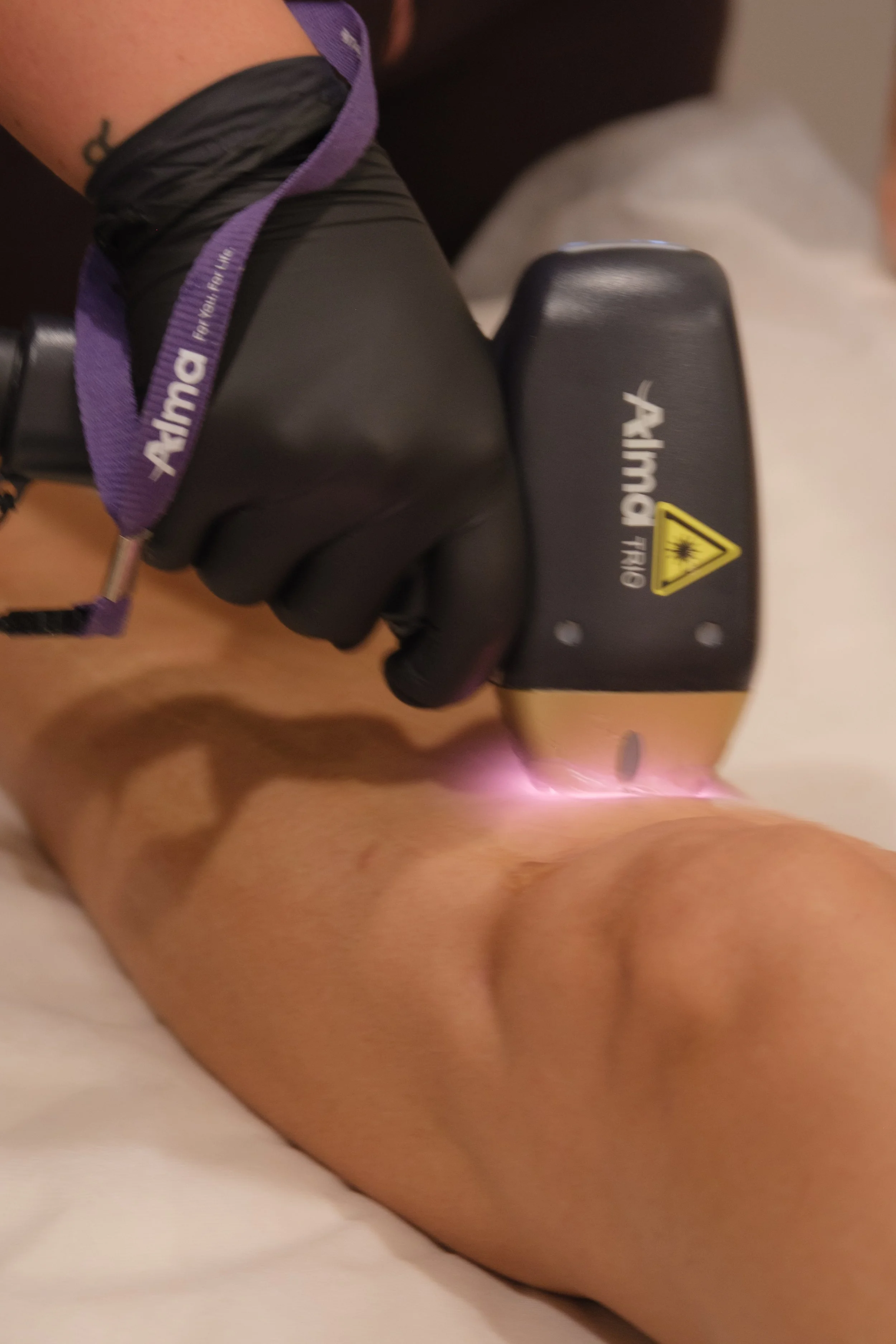 Soprano laser hair removal at rejuved Bateau Bay