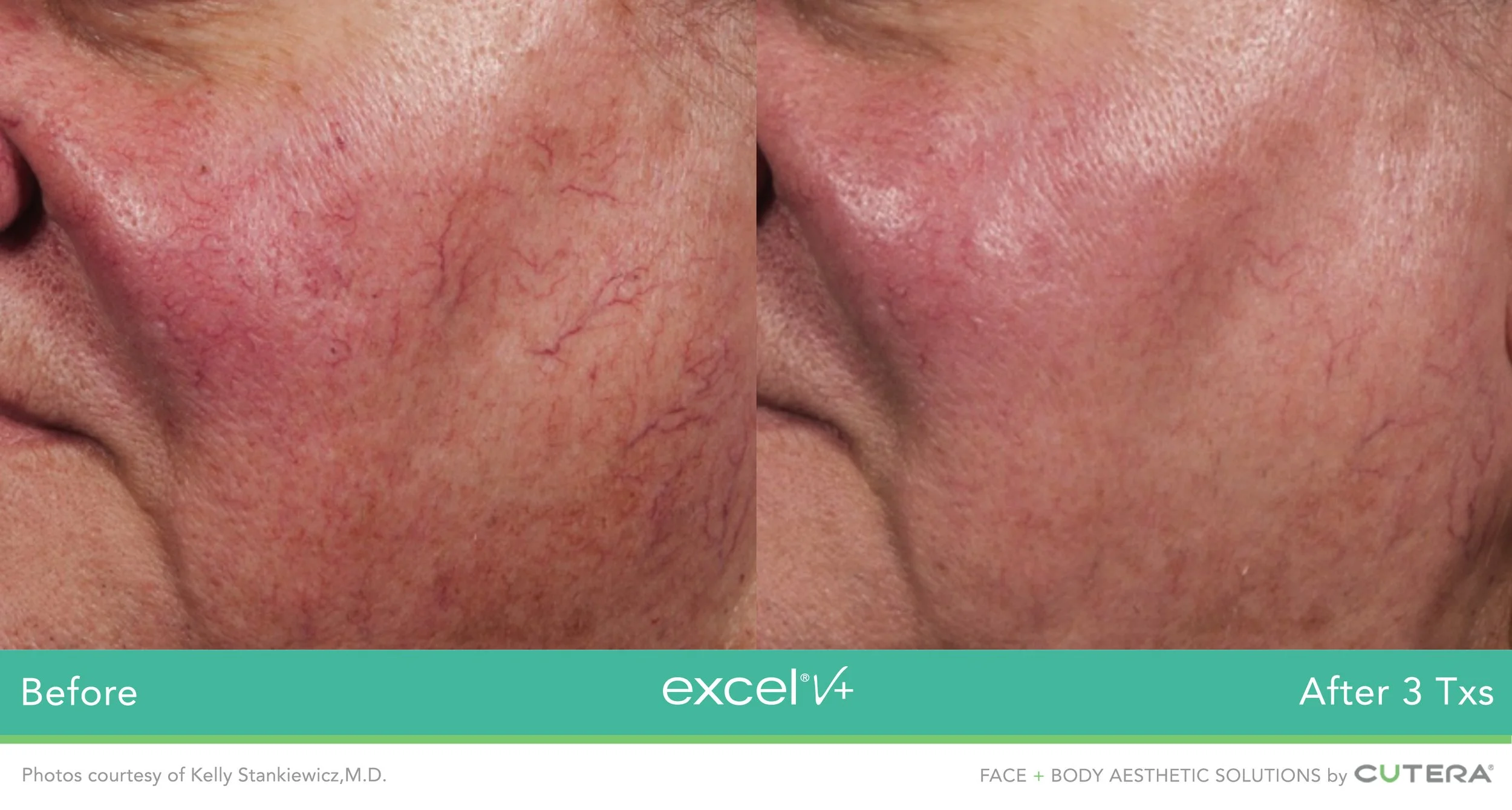 Redness, Rosacea & Vascular laser | Enhance Your Skin Today — Rejuved
