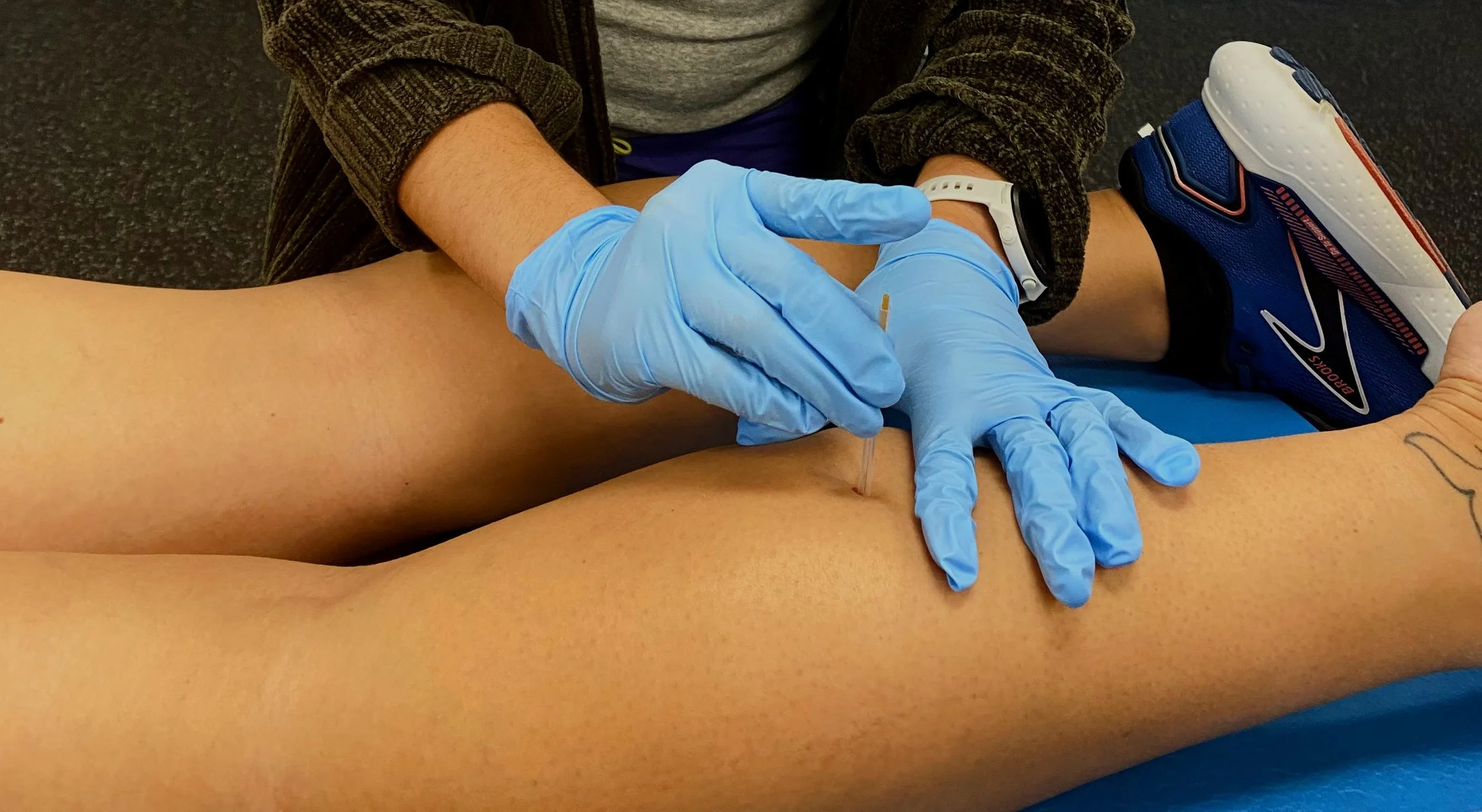 Physical therapist performing dry needling to reduce inflammation, muscle tension, and improve mobility and muscle activation.