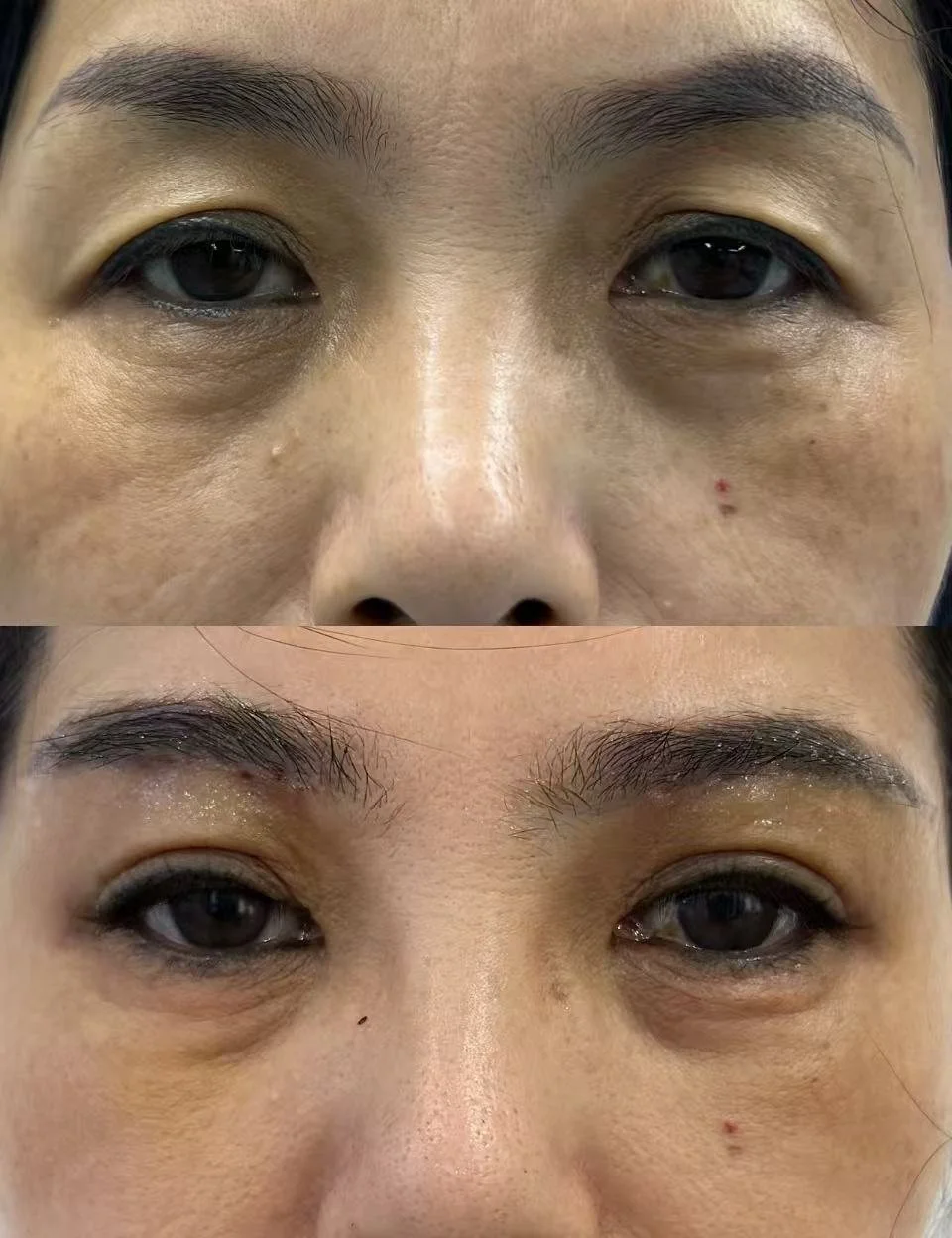 Close-up of a person's face showing before and after close-up of eye area, highlighting improvements in under-eye puffiness and skin texture.