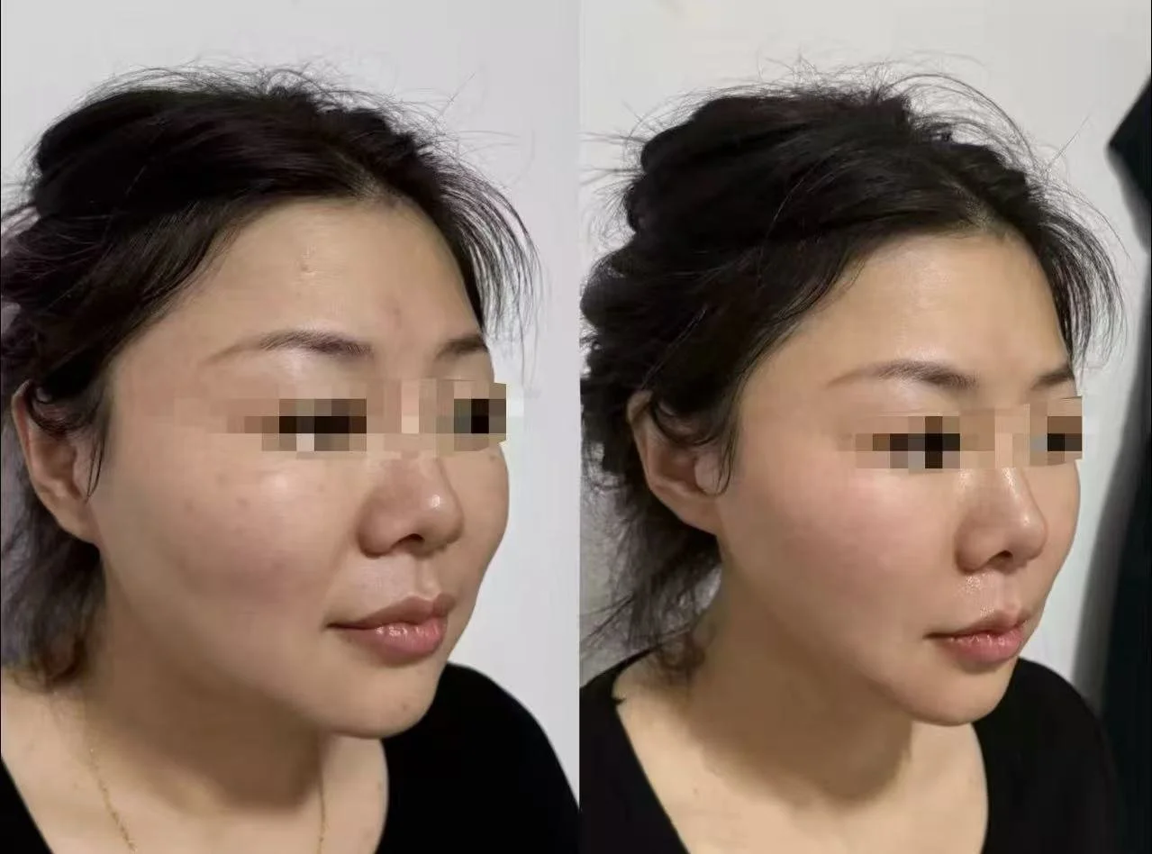 Comparison of a woman's face before and after skincare treatment, showing smoother and clearer skin with improved texture and glow.