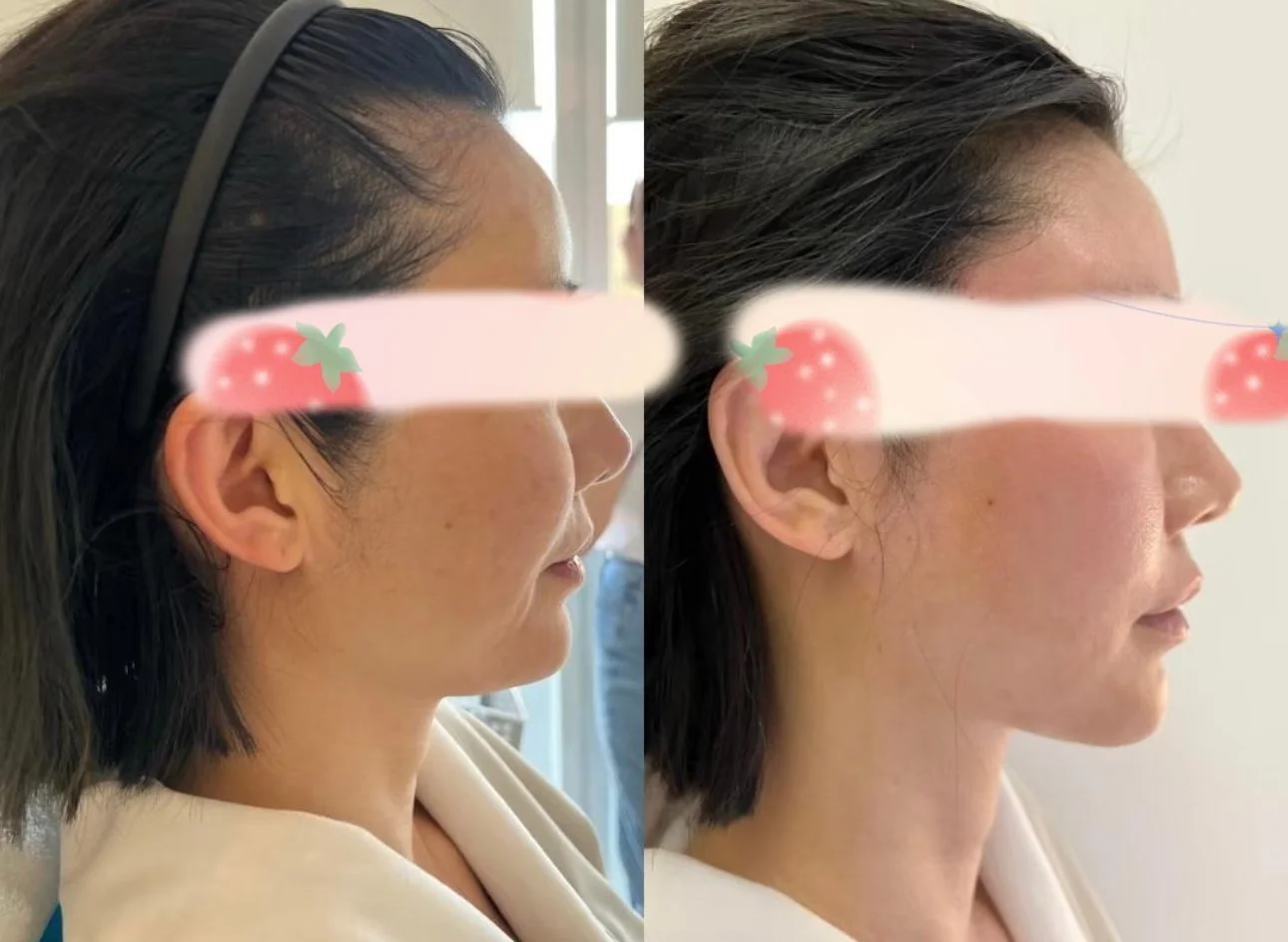 Side-by-side comparison of a woman's profile before and after a skincare treatment showing smoother skin after the procedure.