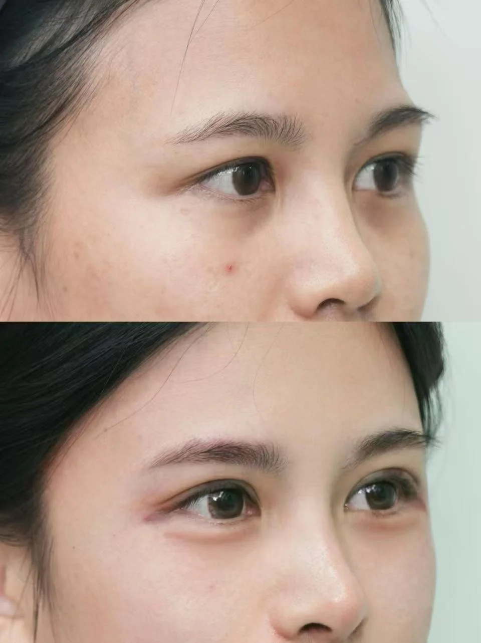 Close-up of a woman's face showing a comparison of her skin before and after treatment, highlighting skin improvement and reduced blemishes.