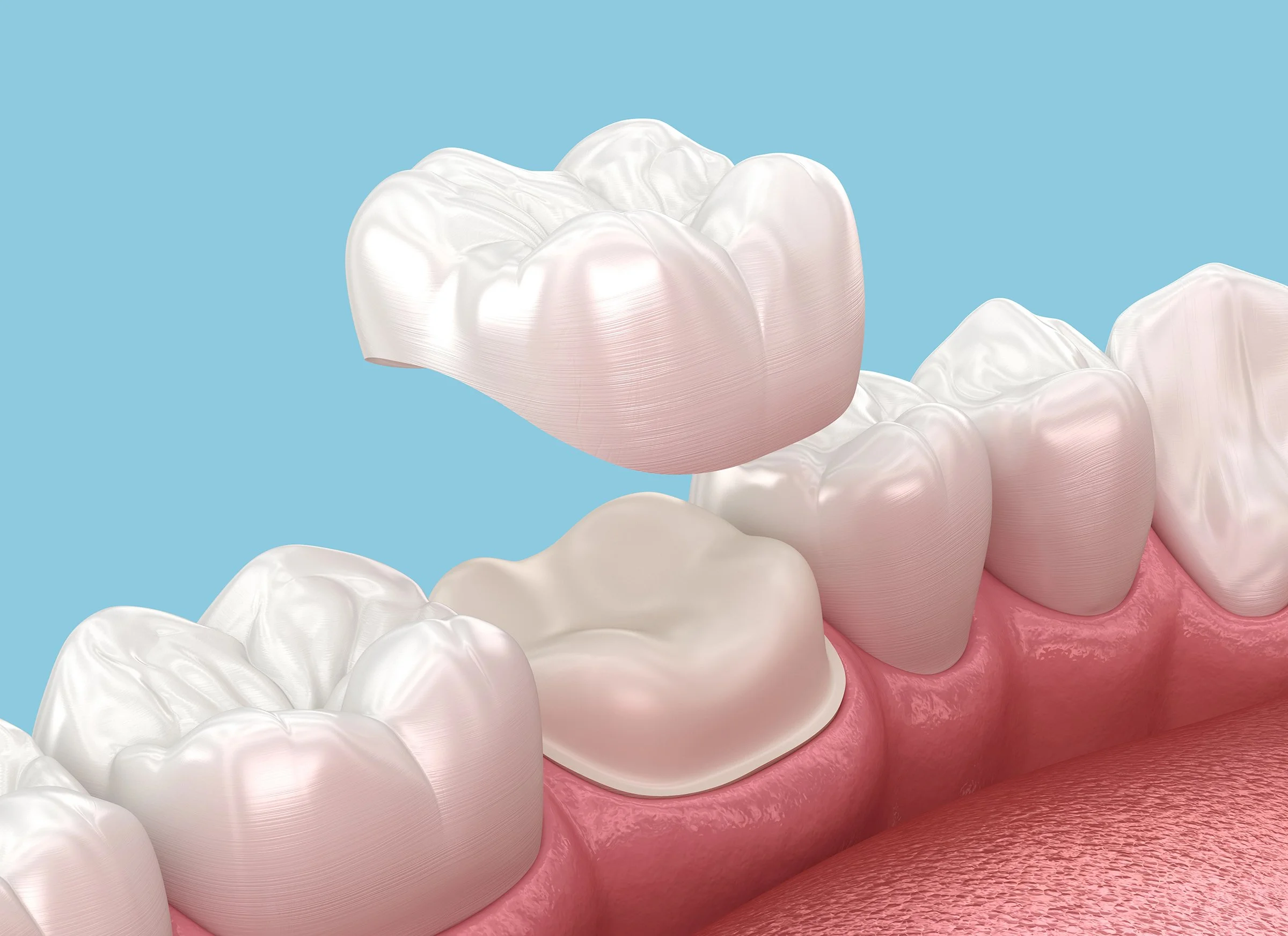 softly dental dental crown.jpg