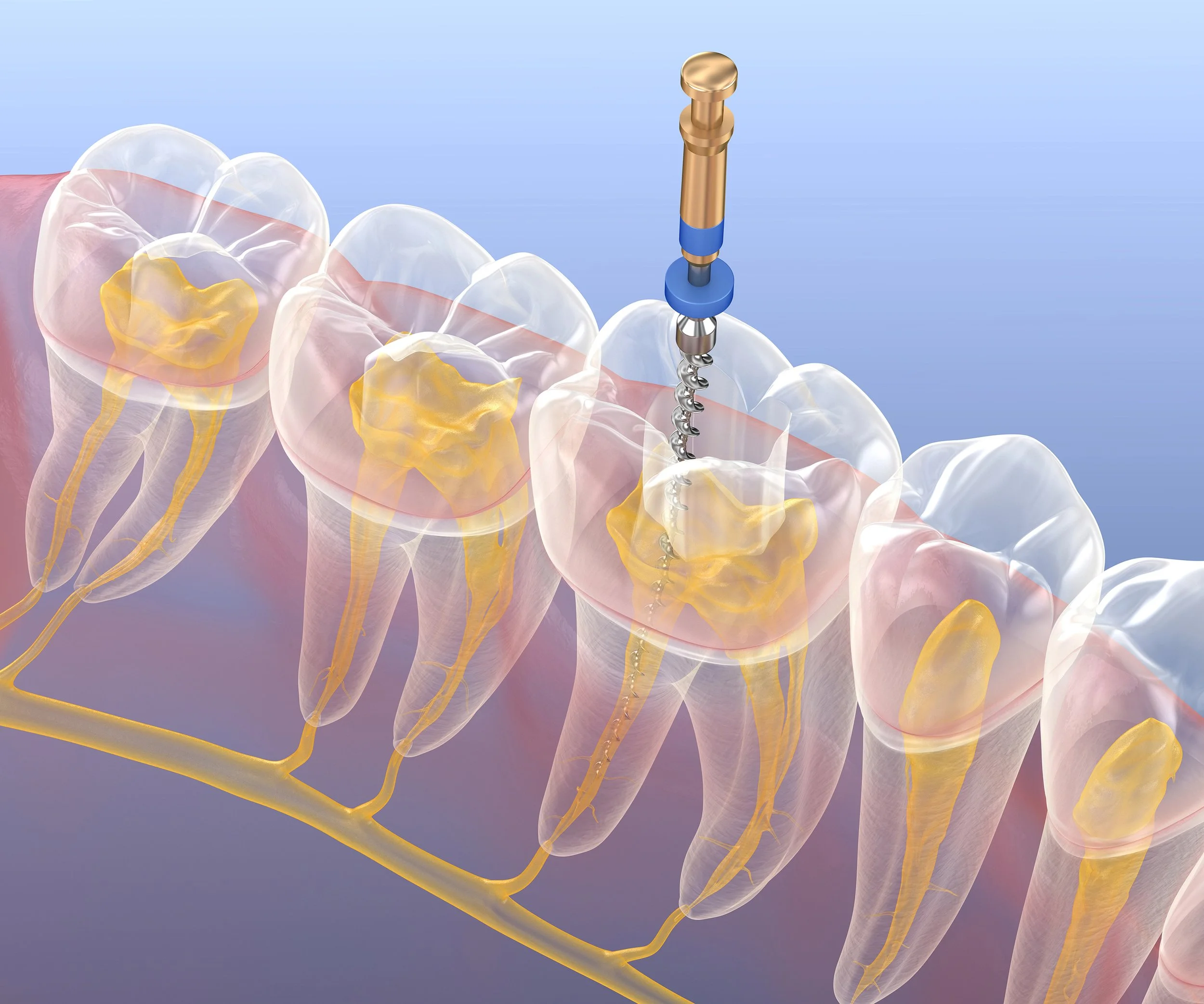 softly dental root canal 1.jpg