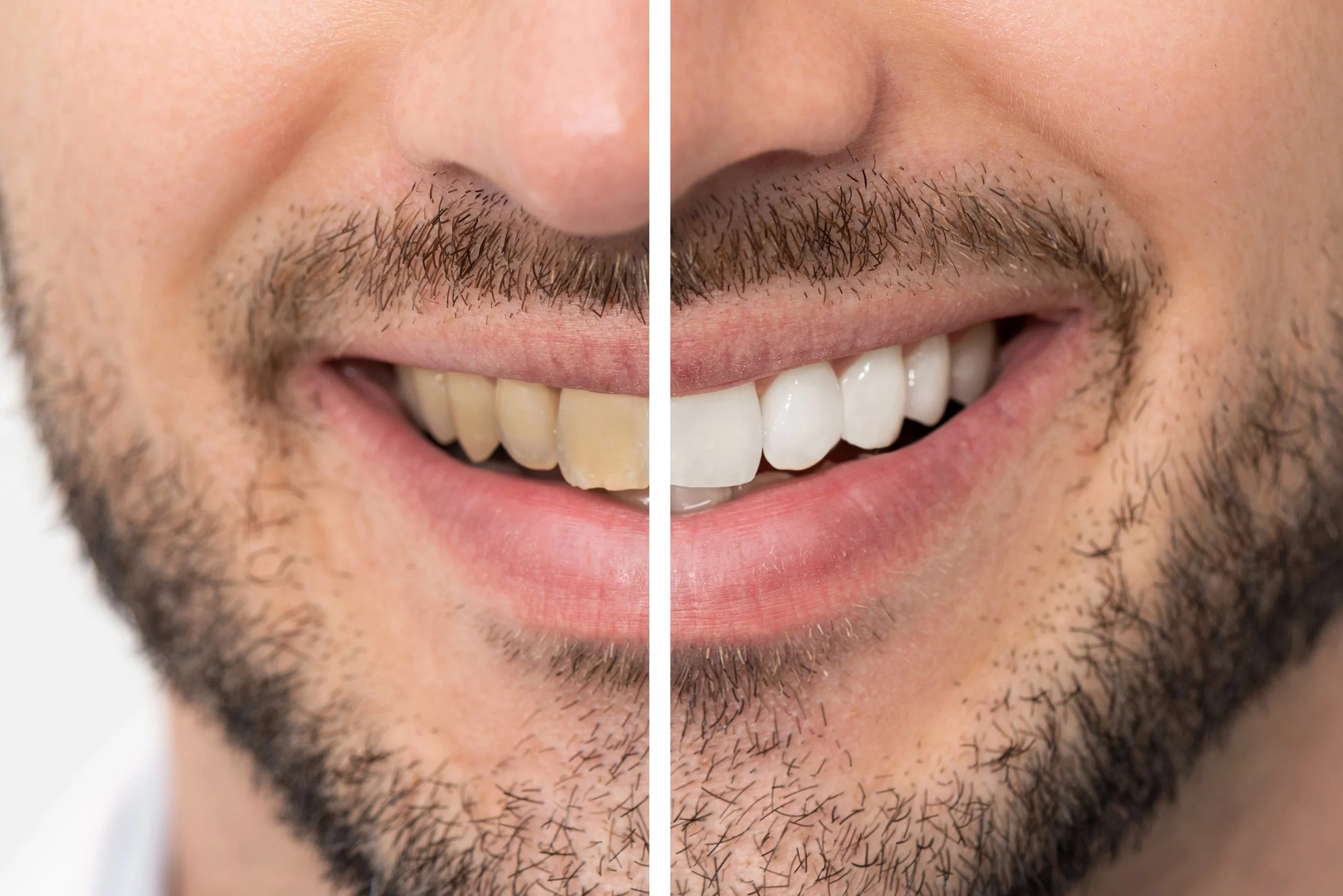 softly dental teeth whitening.jpg