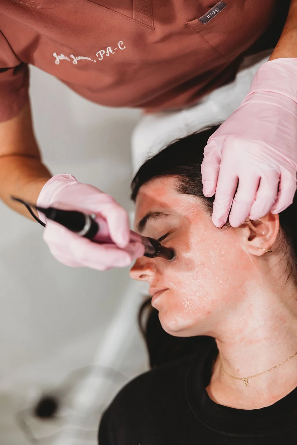 Microneedling collagen induction therapy treatment Lumora Medical Aesthetics Encinitas California