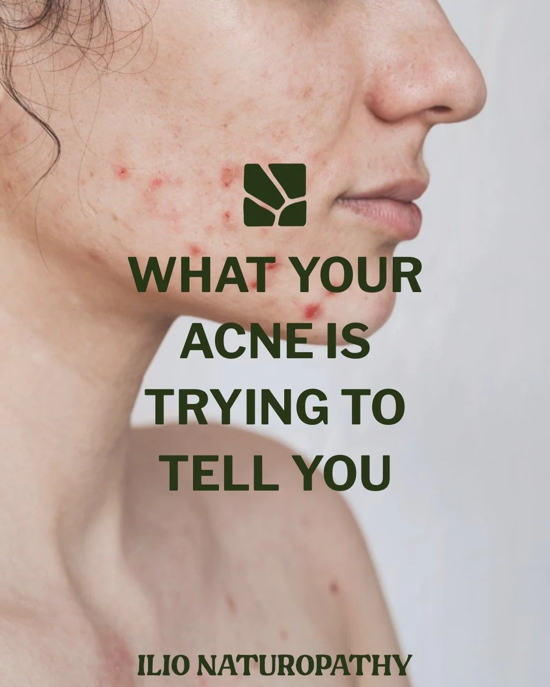 Our skin is one of our greatest messengers, reflecting what is happening beneath the surface.

When we experience internal imbalances from food sensitivities, hormonal fluctuations, gut dysbiosis, or stress, our skin is often the last place to show s