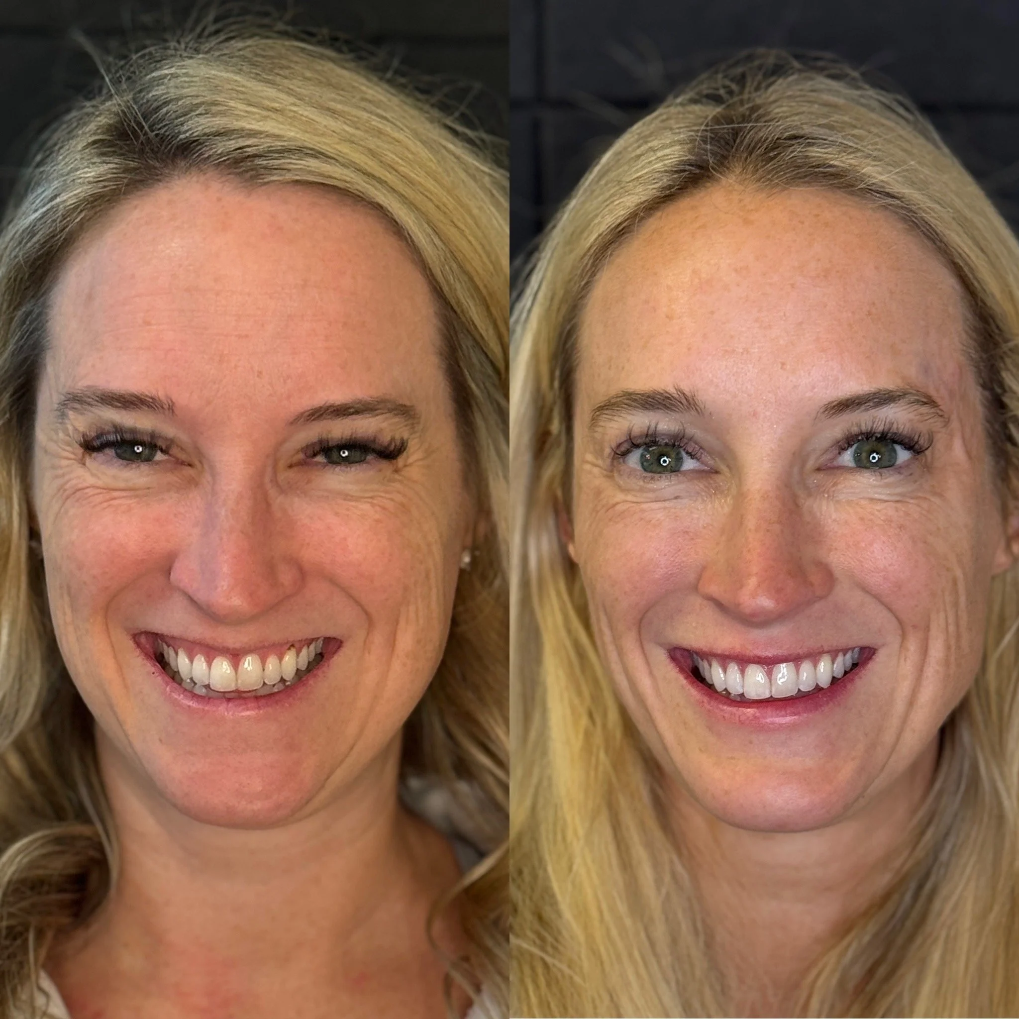 5 Signs It Might Be Time for Botox (And 5 Signs It Isn't)