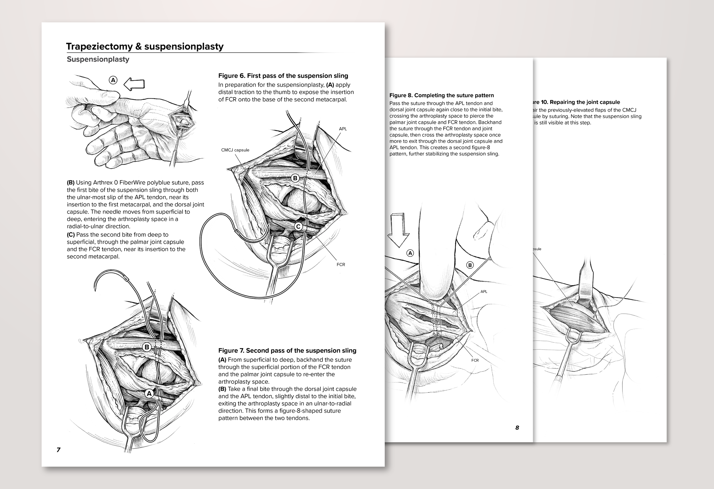 Suspensionplasty following trapeziectomy (Illustrated surgical sequence – Procreate, Illustrator)