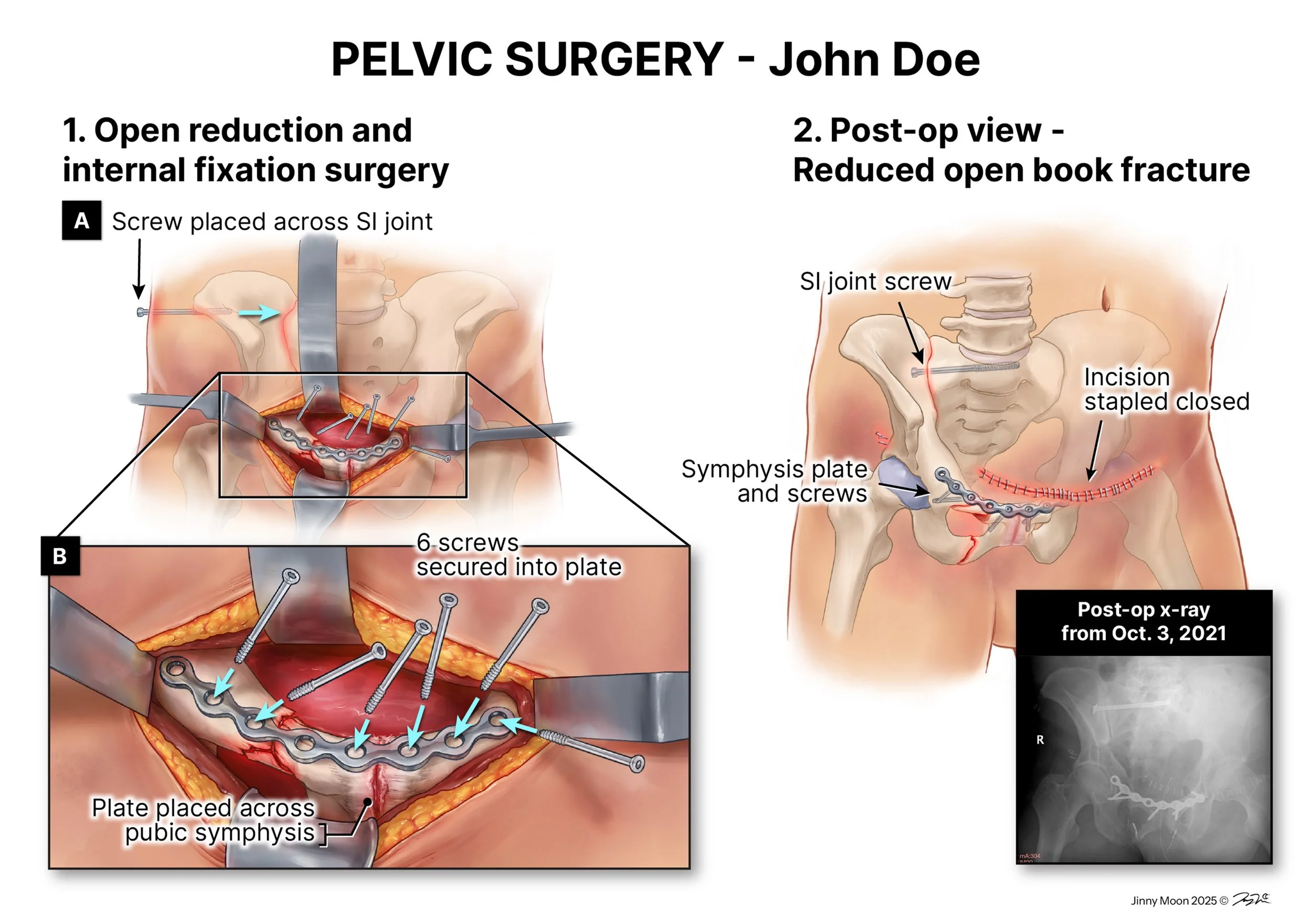 Pelvic surgery (Medical-legal exhibit – Procreate, Illustrator)