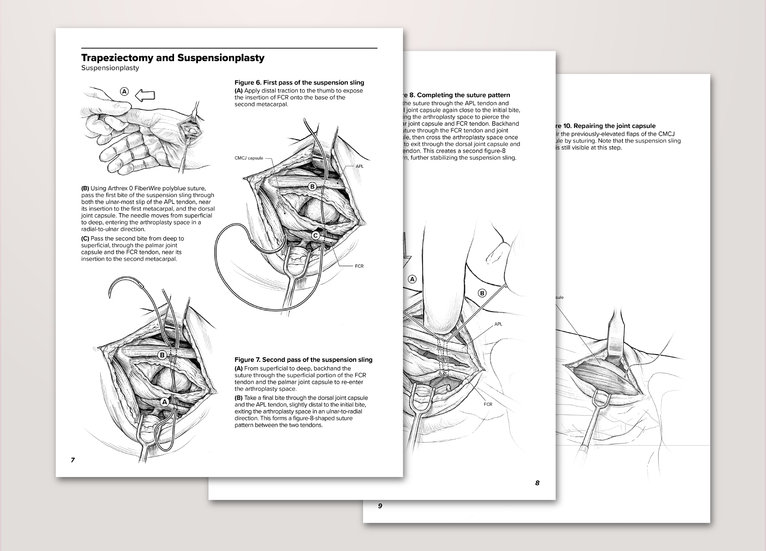 Suspensionplasty following trapeziectomy (Illustrated surgical sequence – Procreate, Illustrator)