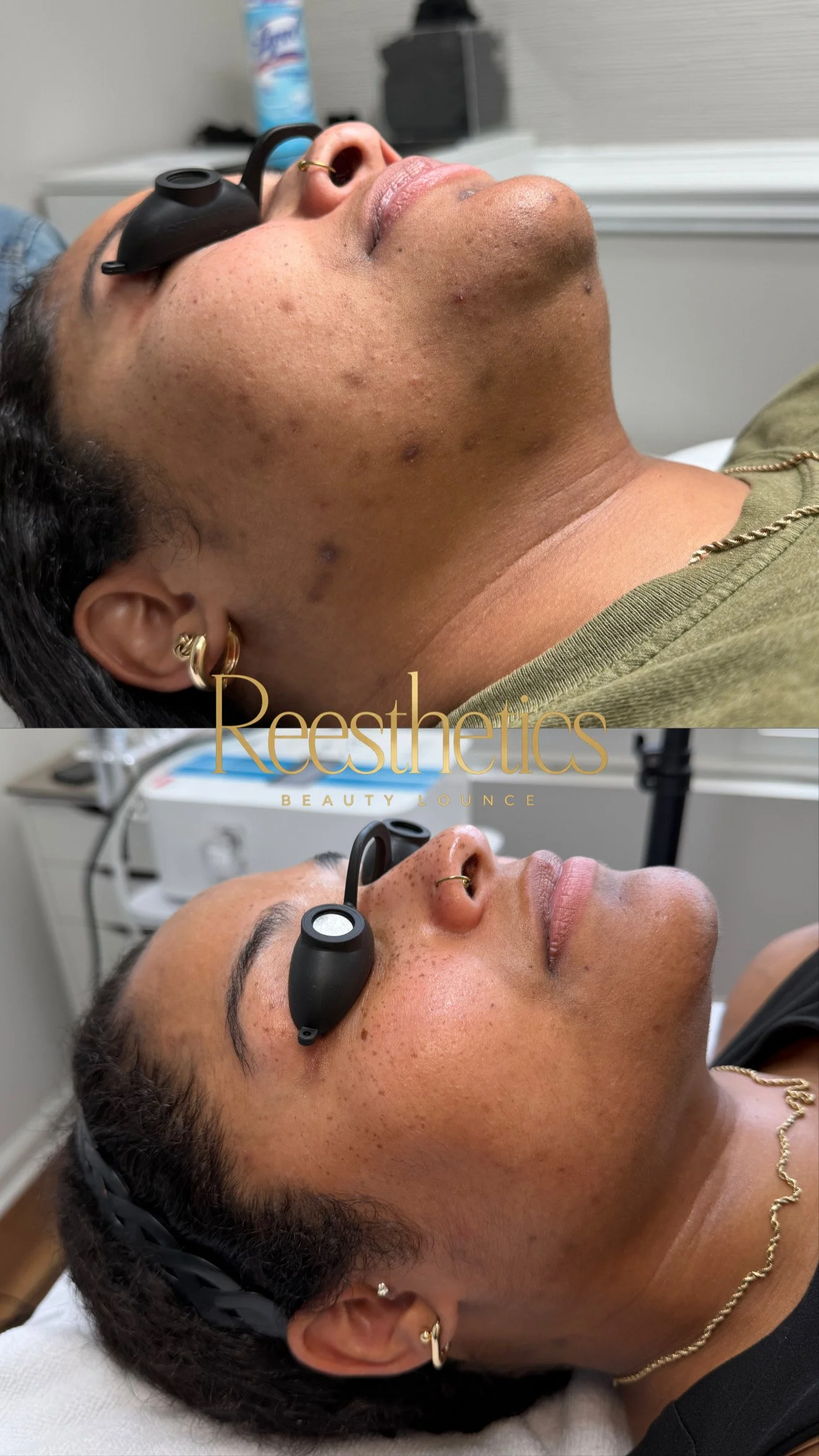 Albiana Skin Transformation.JPG
