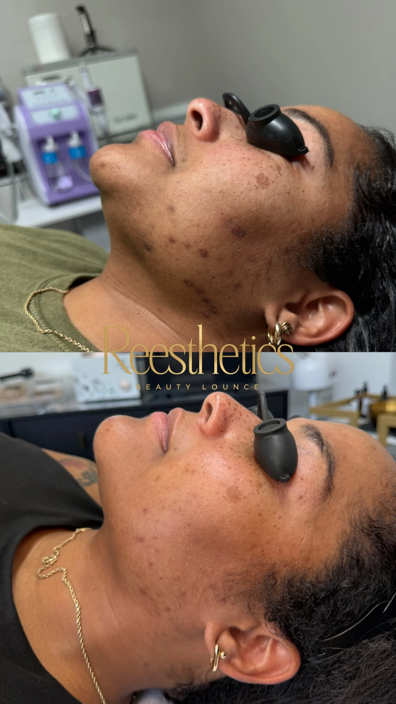 Albiana Skin Transformation 2.JPG