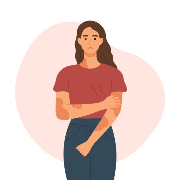 Illustration d'une femme avec des plaques rouges et des boutons sur la peau, montrant une réaction allergique ou une irritation.