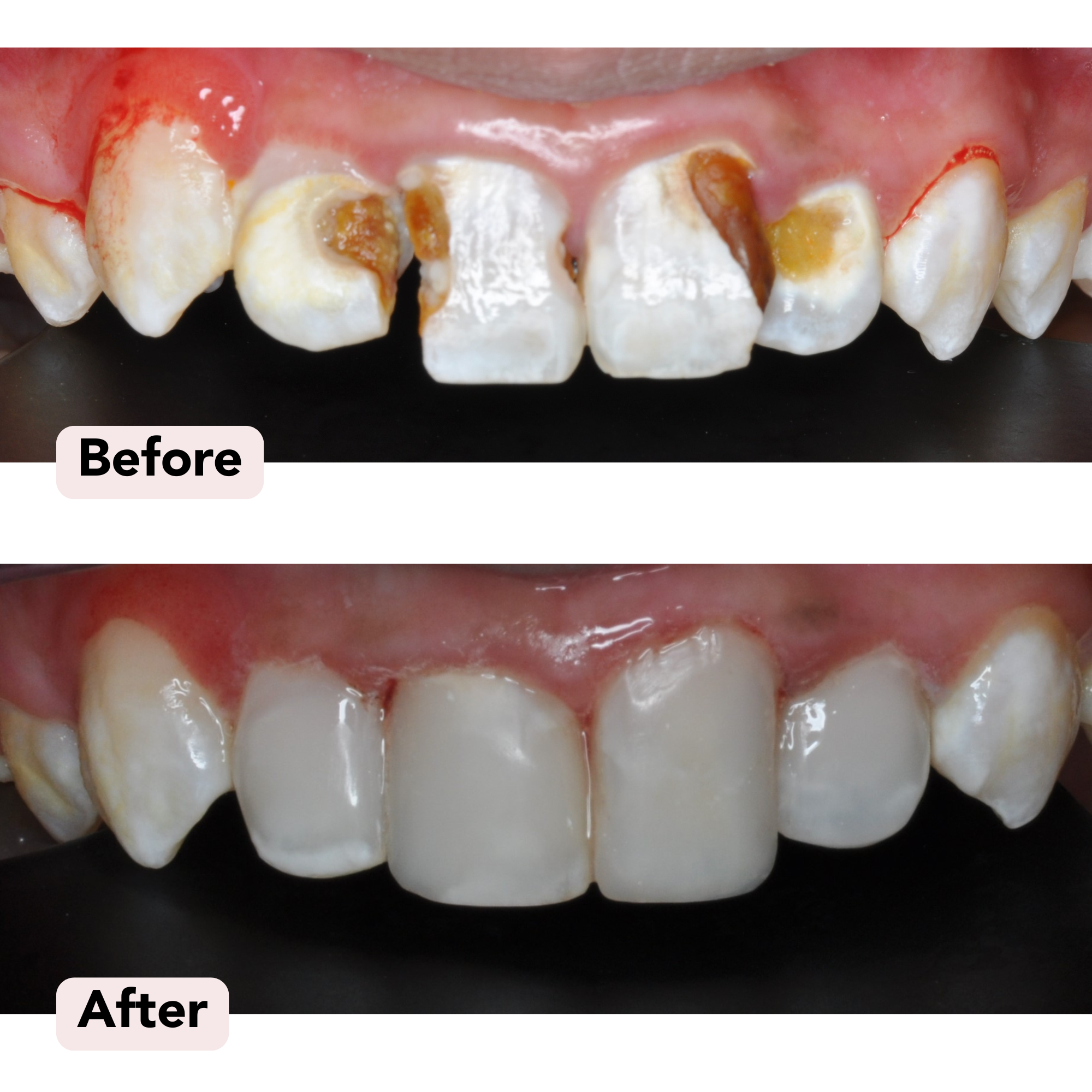 composite veneers Before-After.png