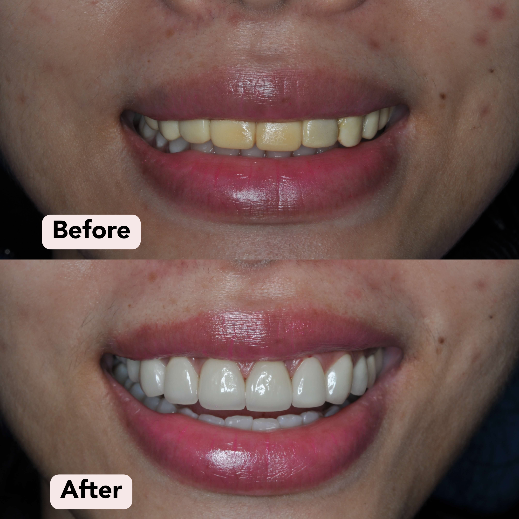 Porcelain veneers Before-After 2.png