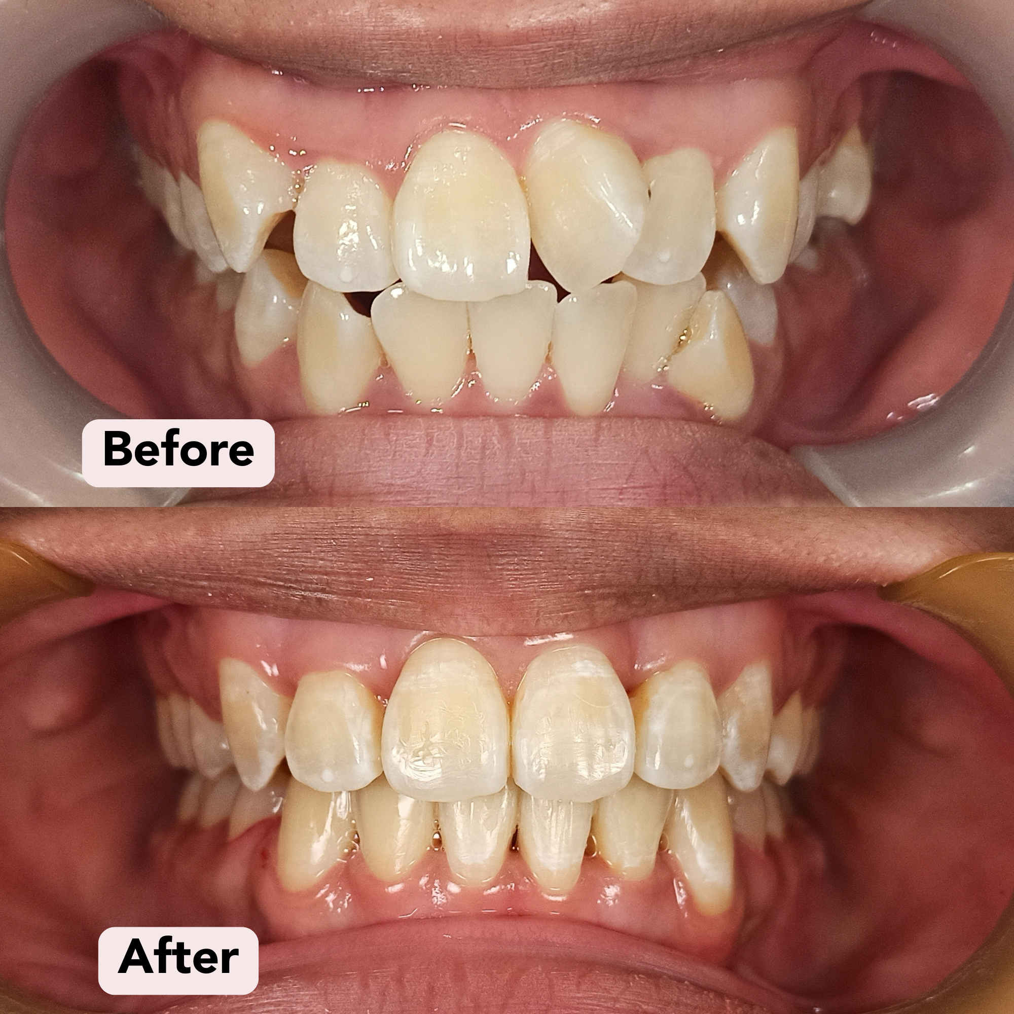2) Braces Dr S Before-After.png