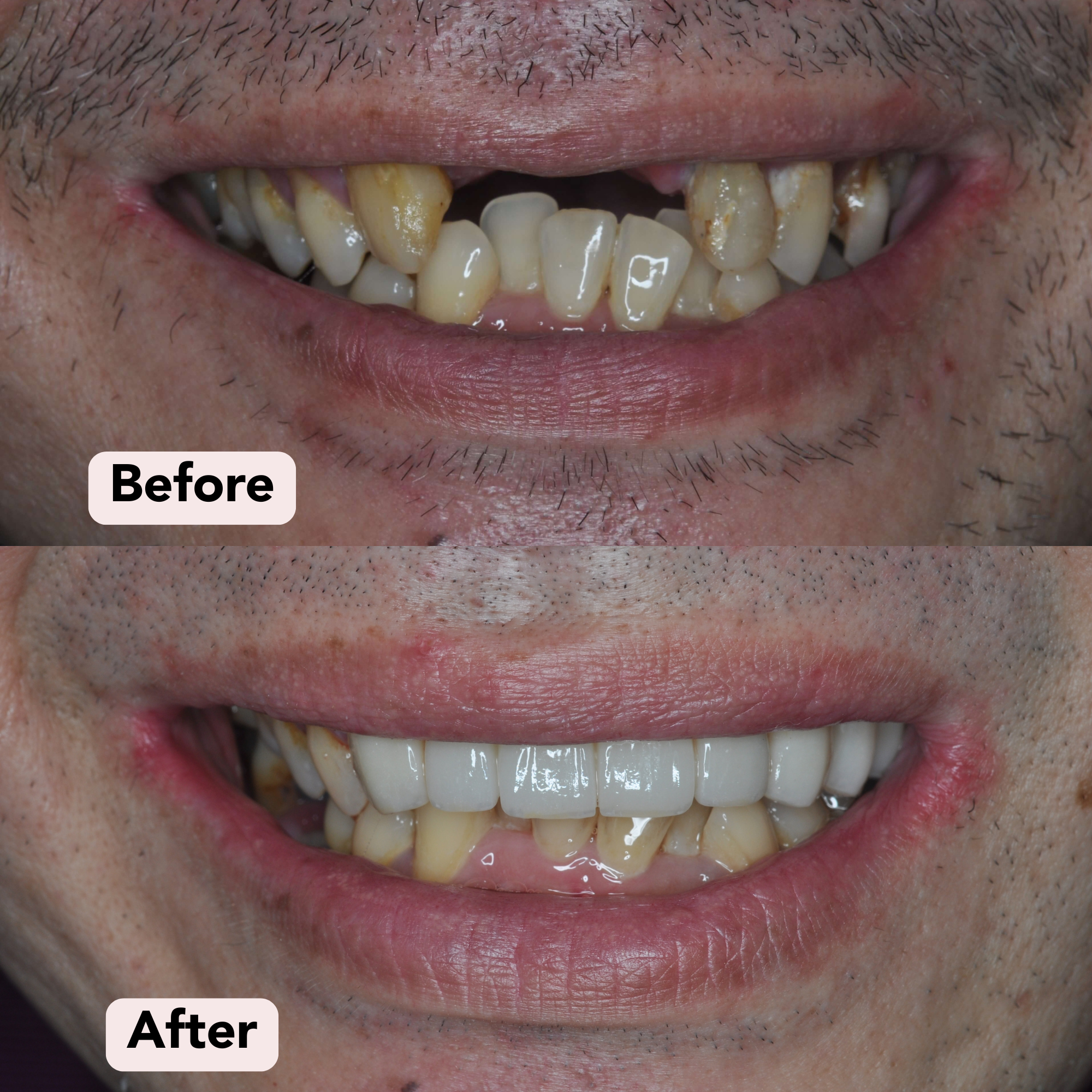 bridge Before-After 2.png