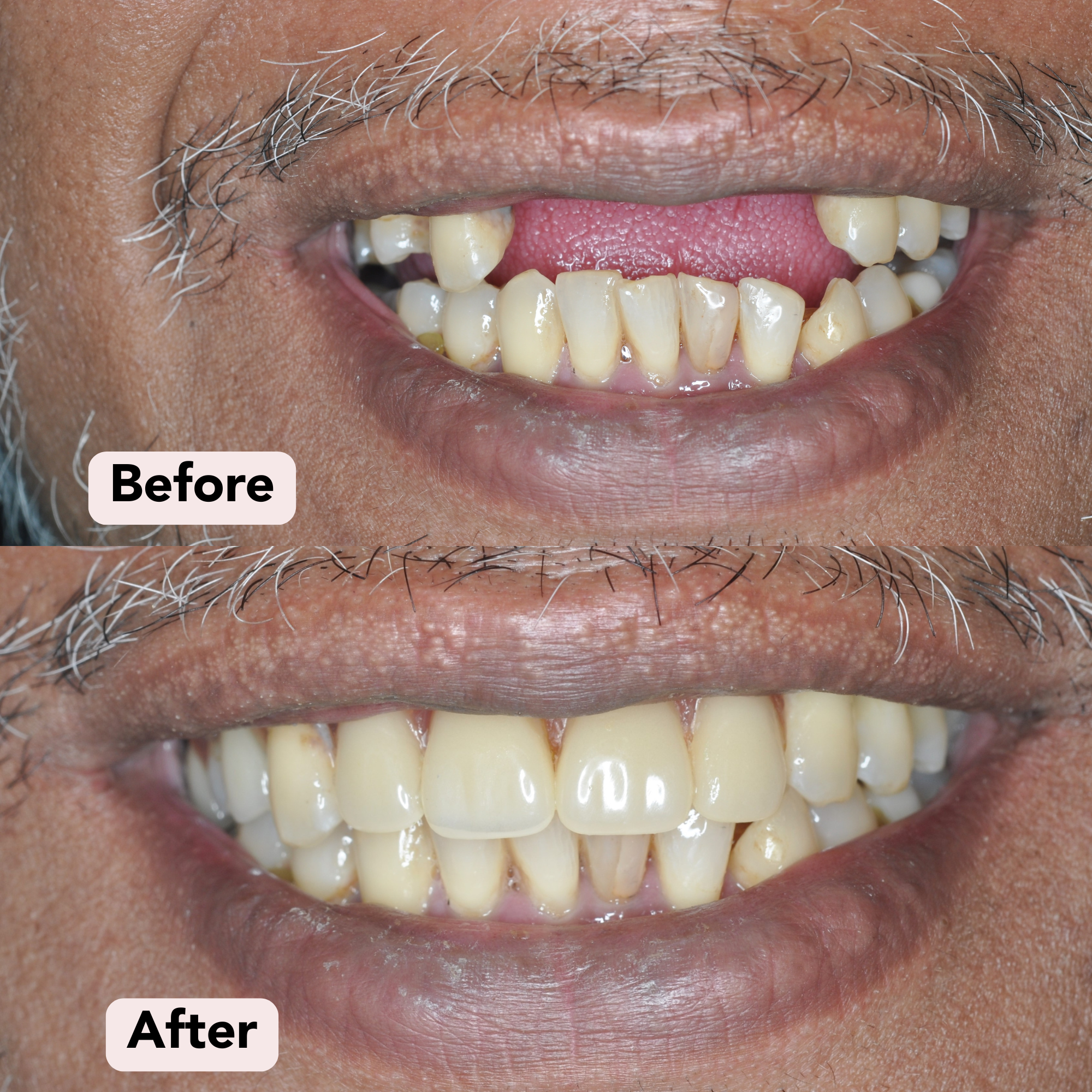 Denture Before-After 2.png