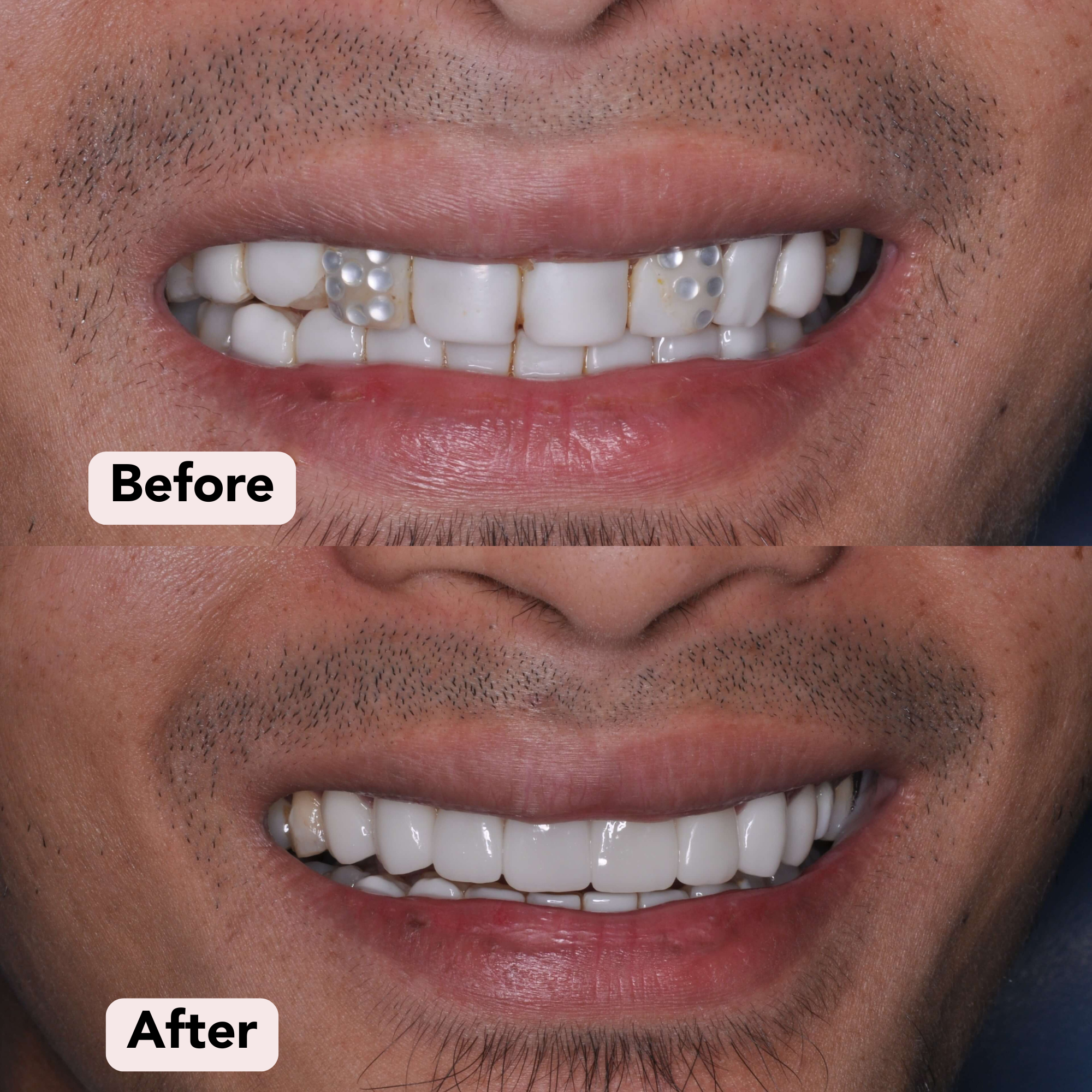 Porcelain veneers Before-After 1.png