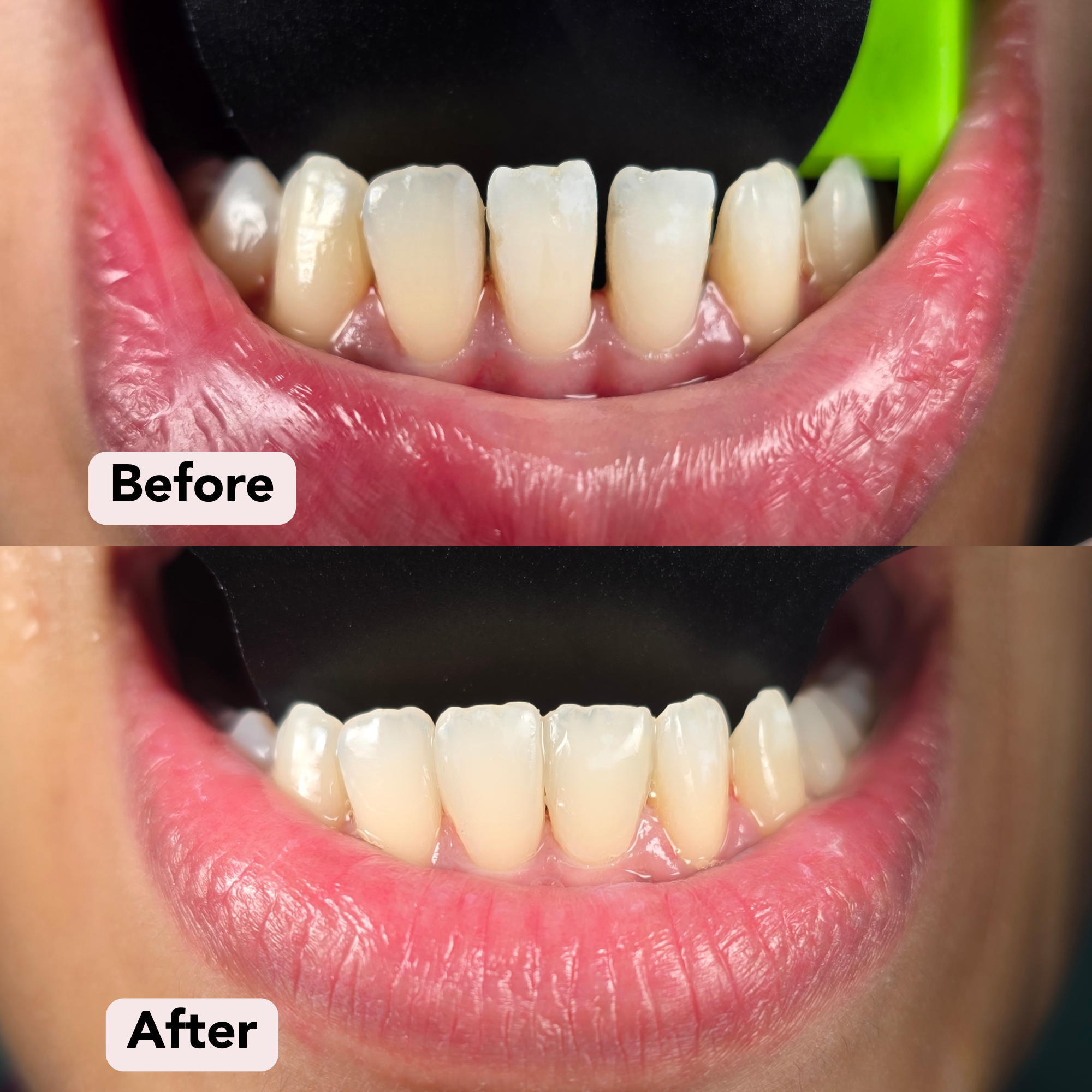 2) Smile Makeover Dr F Before-After.png