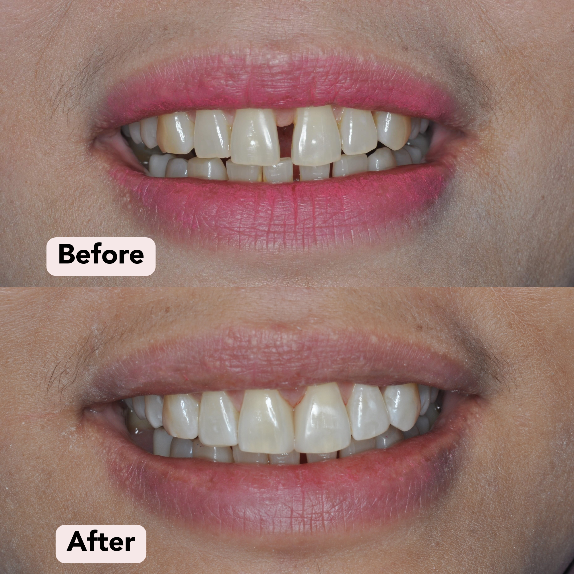 Gap Filling Before-After 1.png