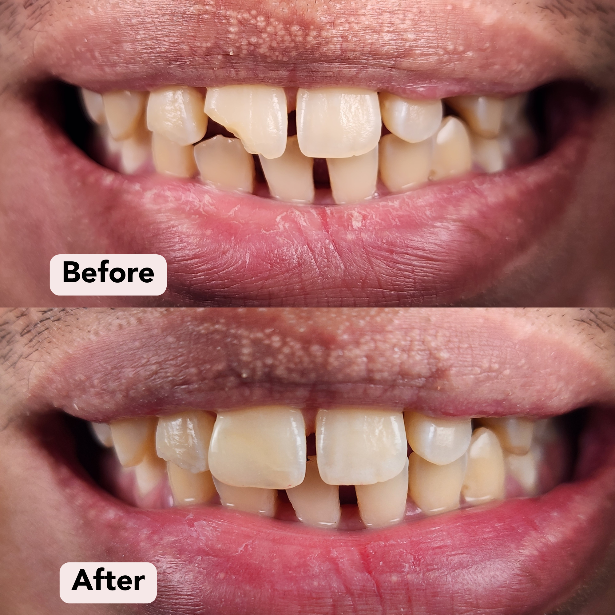 1) Smile Makeover Dr F Before-After.png
