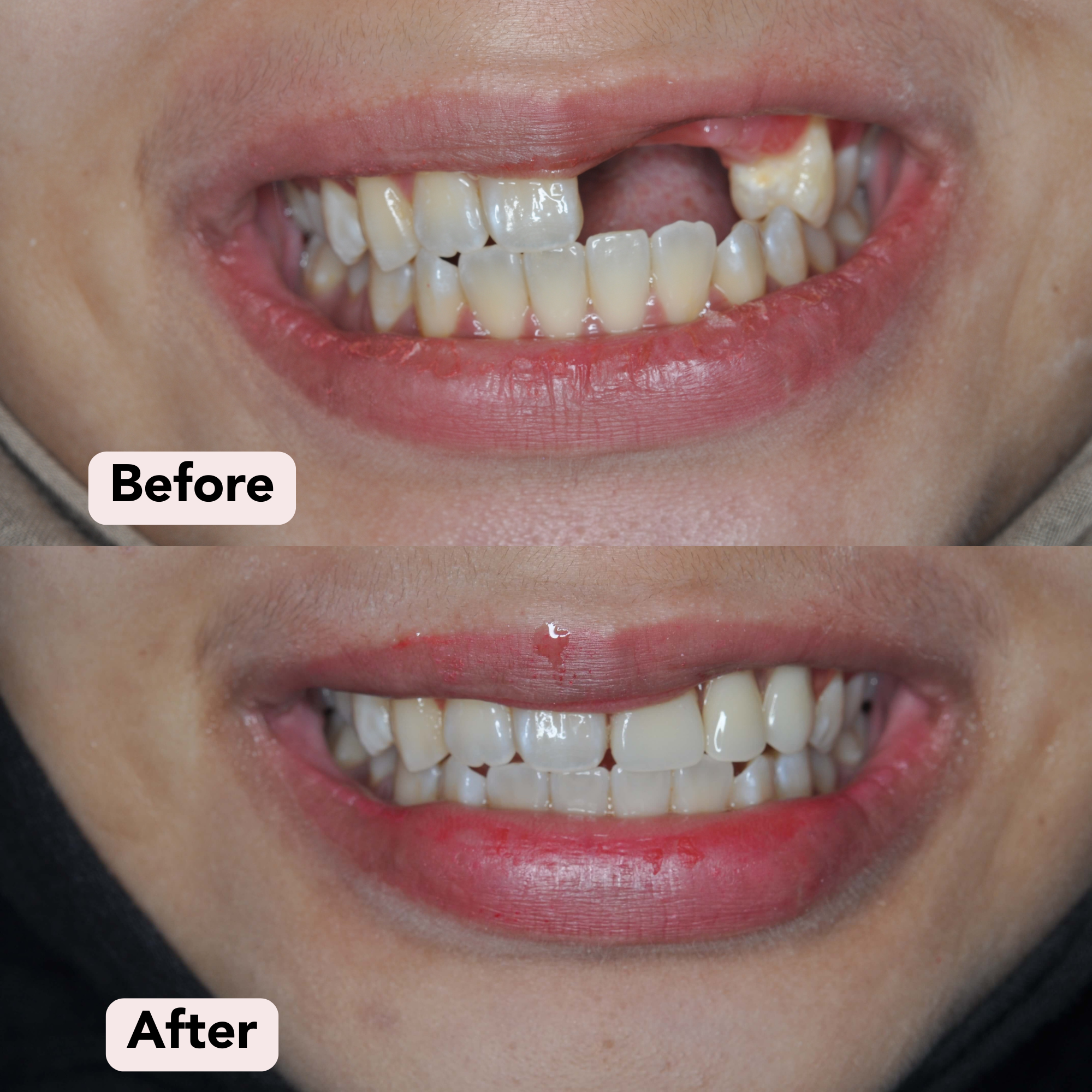 Dentures Before-After 4.png