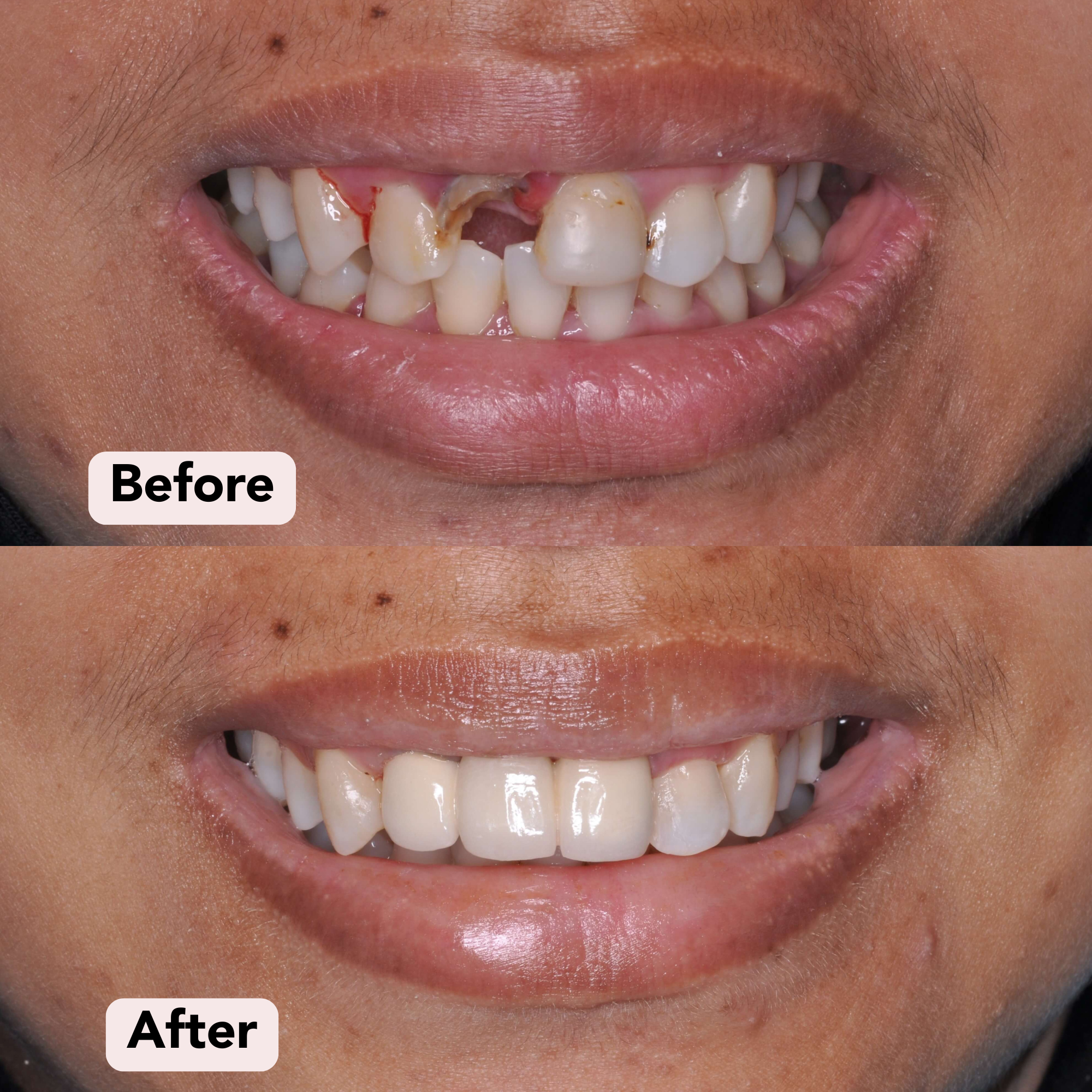 Bridge Before-After 3.png