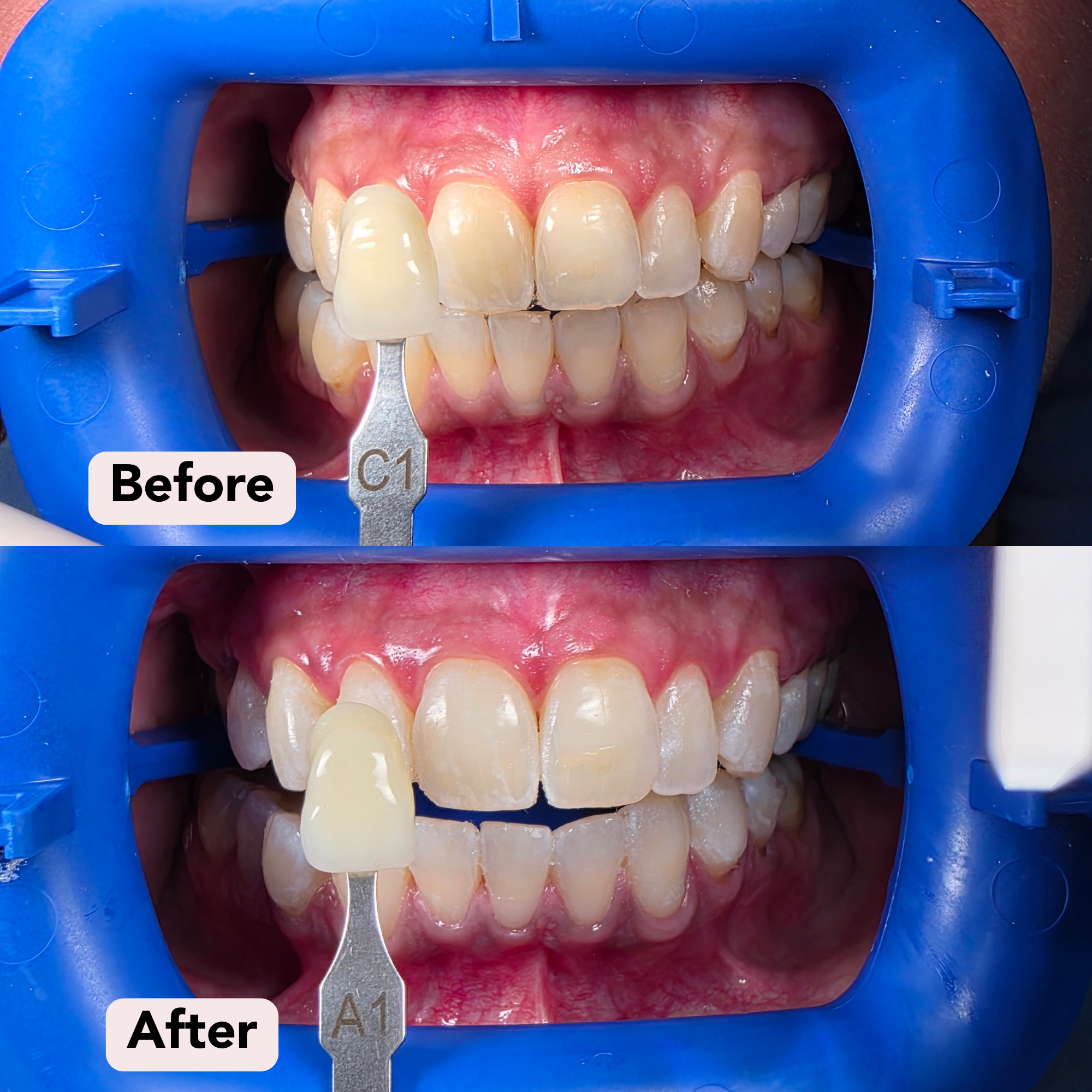7) Smile Makeover Dr F Before-After.png