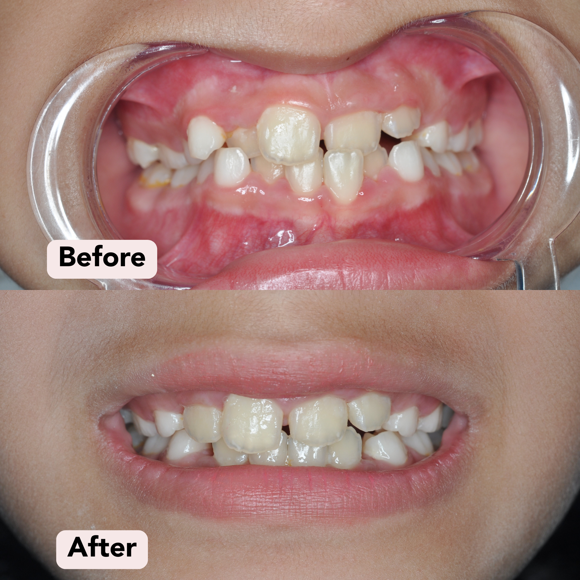 Interceptive orthodontic Before-After.png
