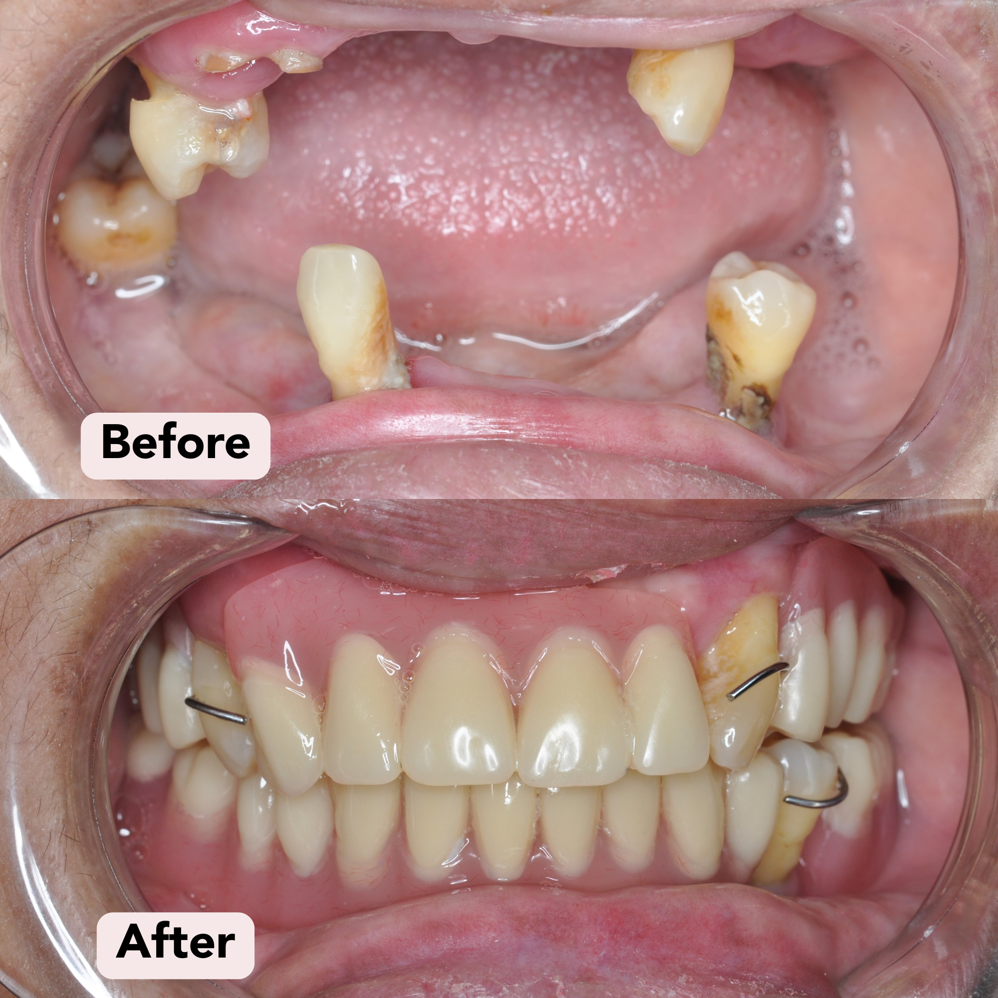 Dentures Before-After 5.png