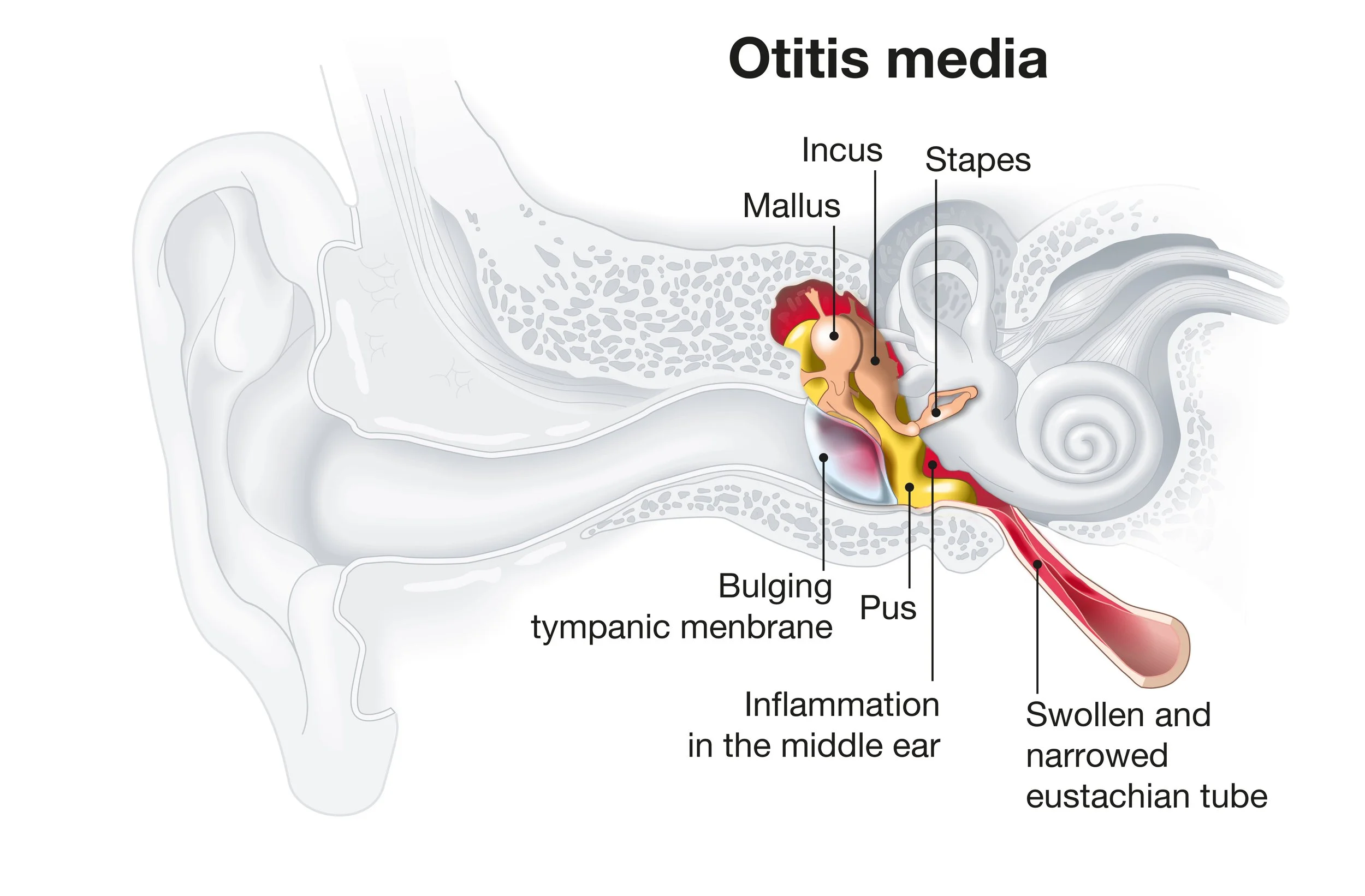 Middle Ear Infection: Symptoms, Causes and How to Treat It  