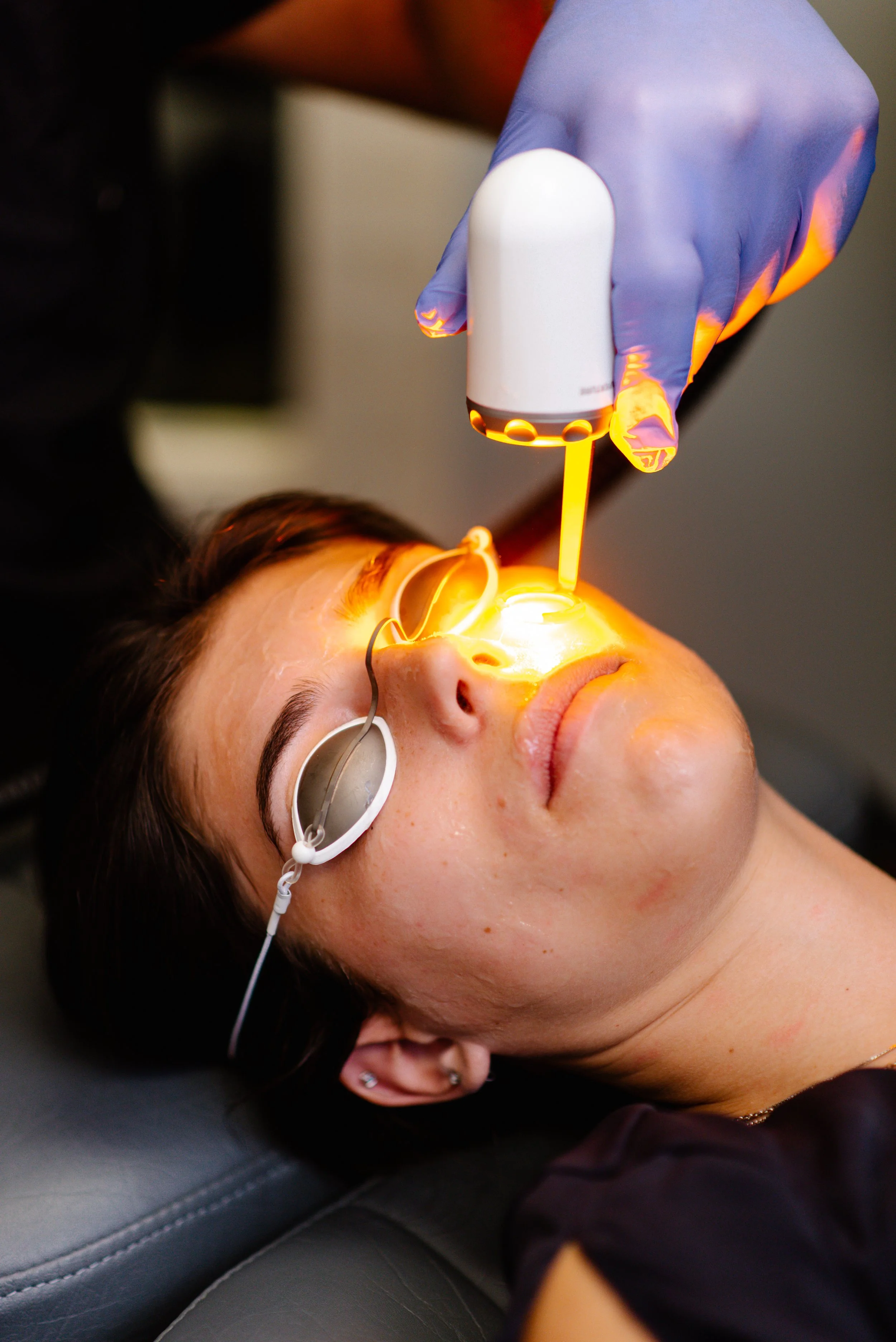 Top 5 Reasons Your Practice Needs an Acne Laser