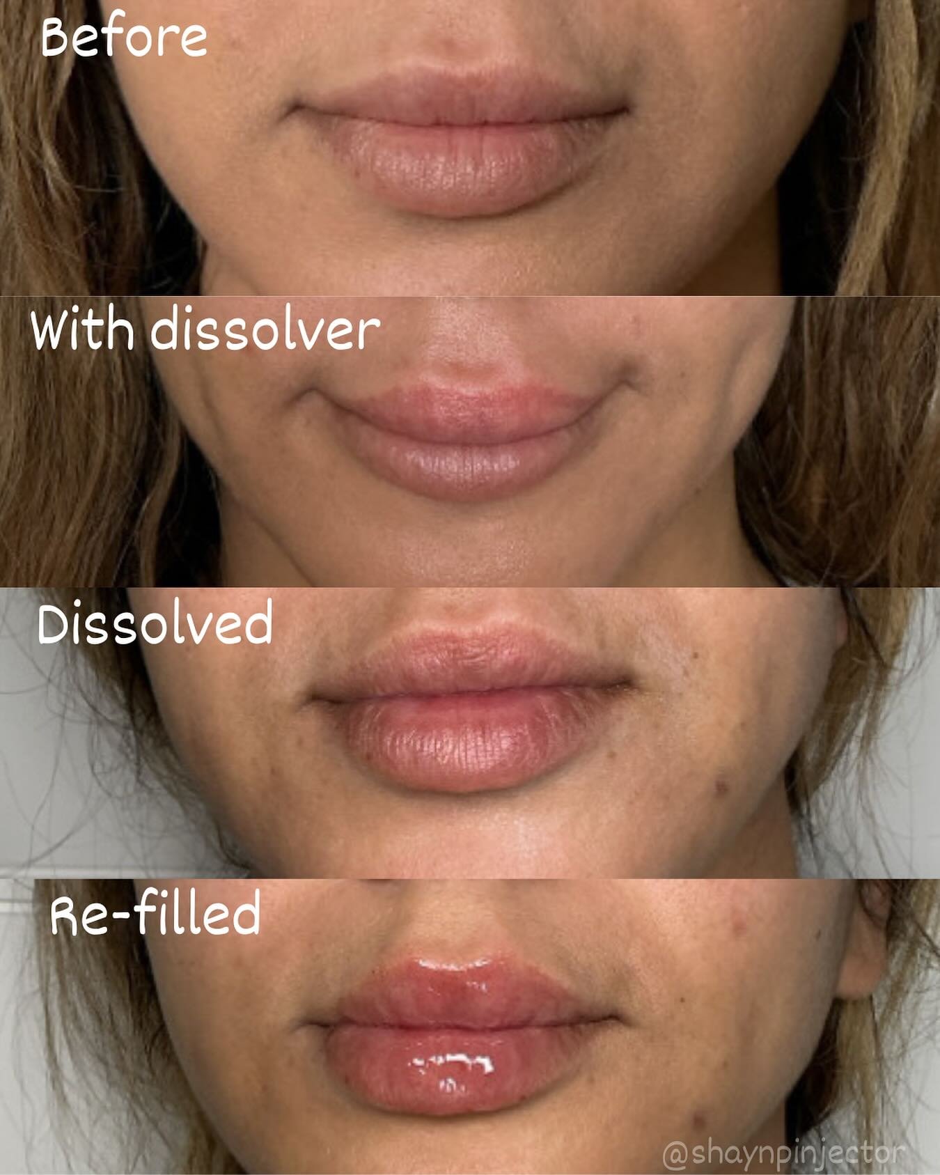 Love a good lip dissolve &amp; refill! 😍

We dissolved top lip only due to migration above vermillion border and also lumpiness within the lip. We refilled using 0.8 ml and a Russian technique per clients request. They turned out stunning! 😍

It&rs